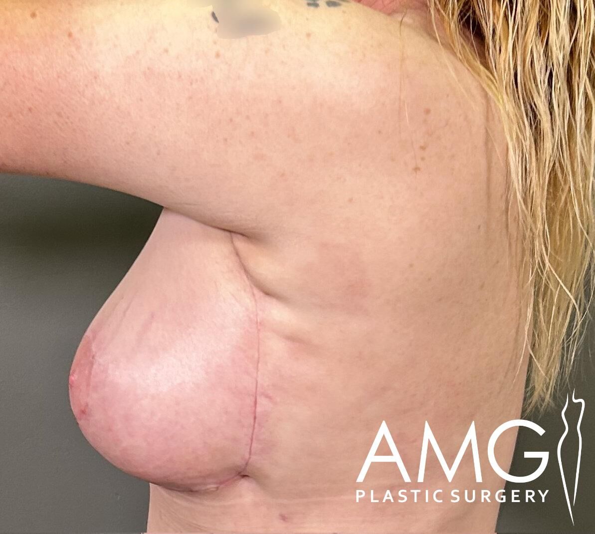 Close-up of a person’s side and breast showing a surgical scar underneath. The image includes an "AMG Plastic Surgery" logo.