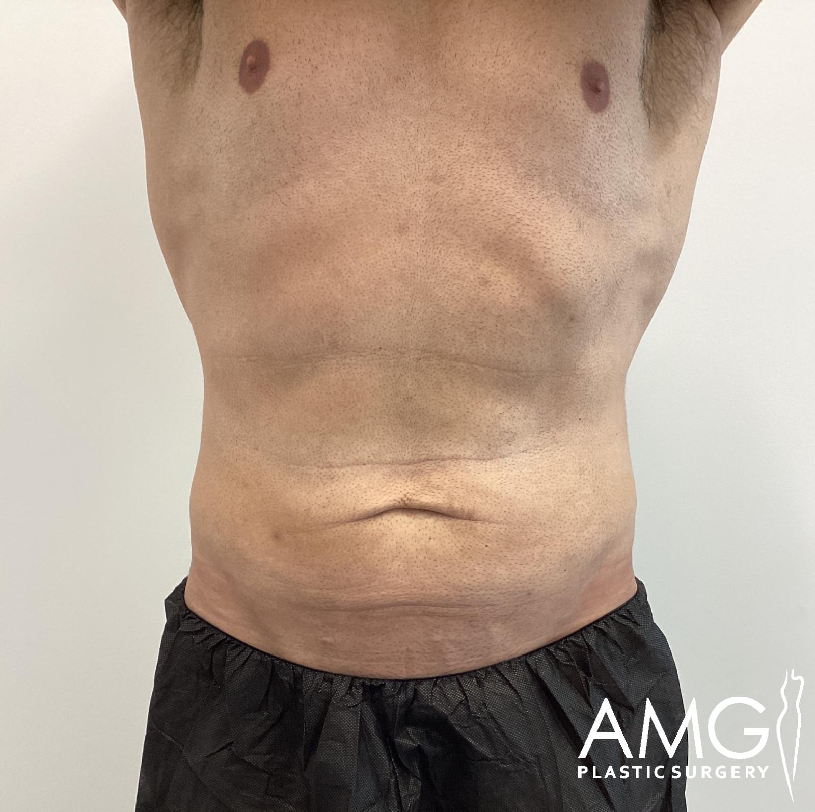 Front view of a man's abdomen before tummy tuck showing excess skin and lax abdominal contour, AMG Plastic Surgery.
