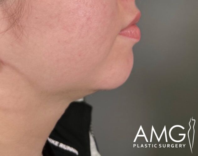 Profile view of a person's chin and neck, showing subtle contours and skin texture. AMG Plastic Surgery logo visible in the lower right corner.