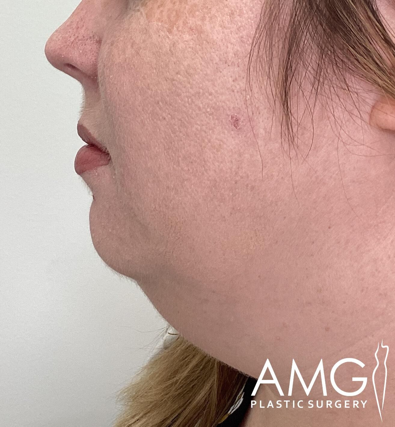 Profile view of a person's face showing a double chin; an 