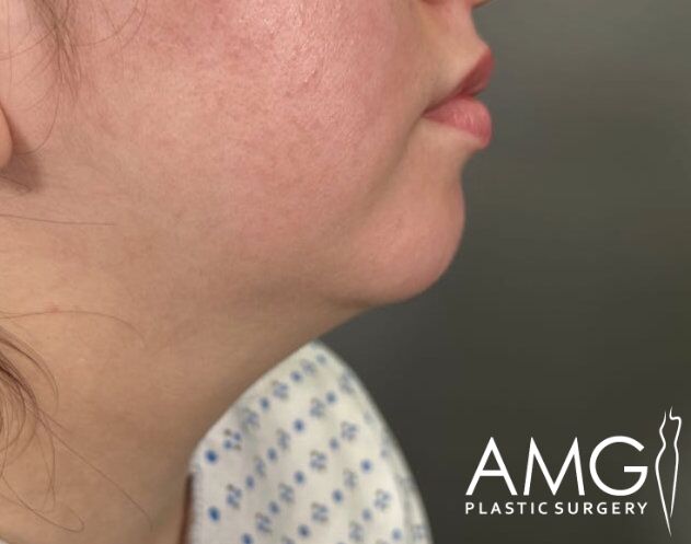 Profile view of a person's lower face and neck wearing a medical gown. Logo of AMG Plastic Surgery is visible in the corner.