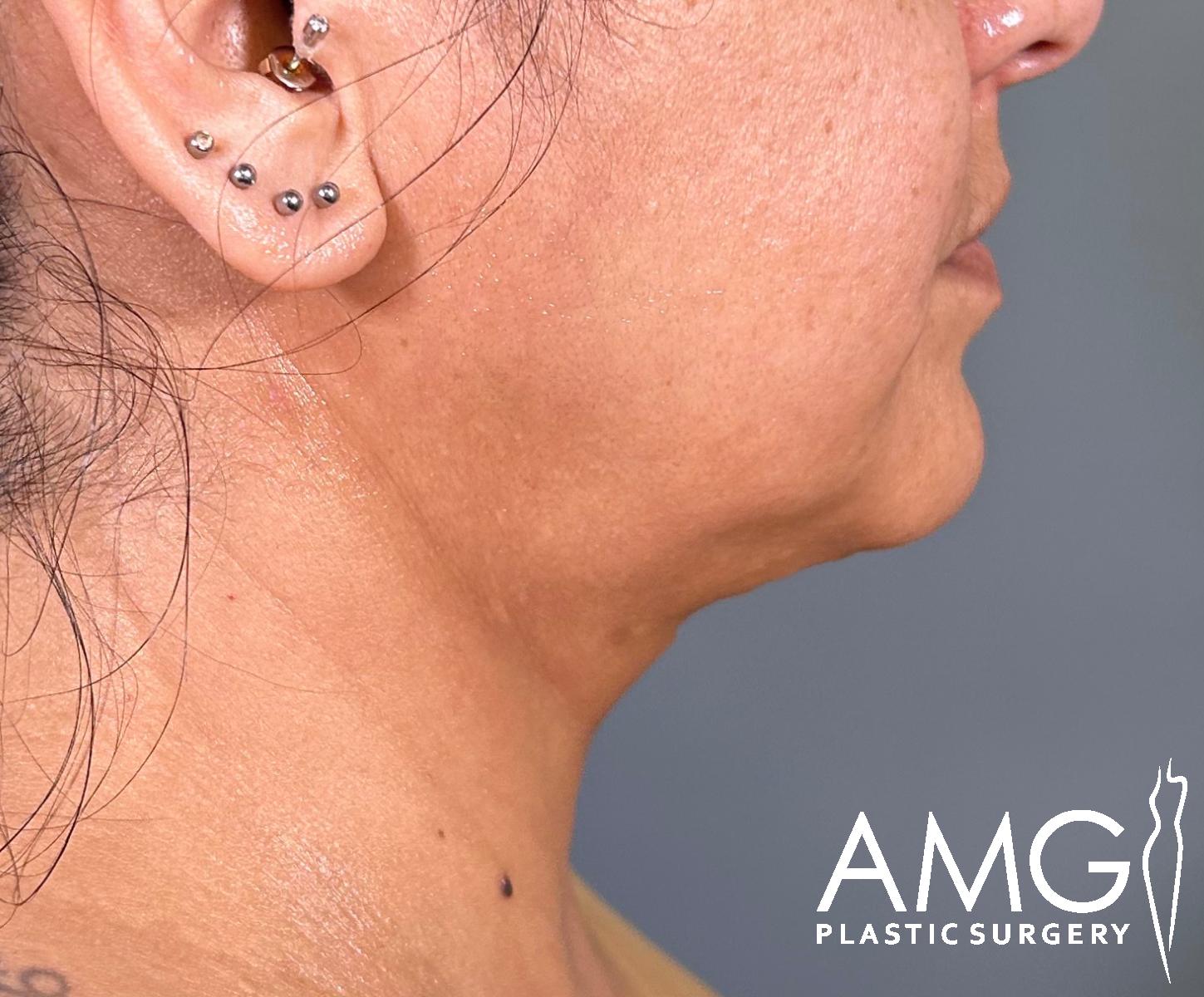 Before and after right side view of a woman’s lower face and neck, showing improved chin and jawline contour after chin liposuction at AMG Plastic Surgery in Herndon, VA.
