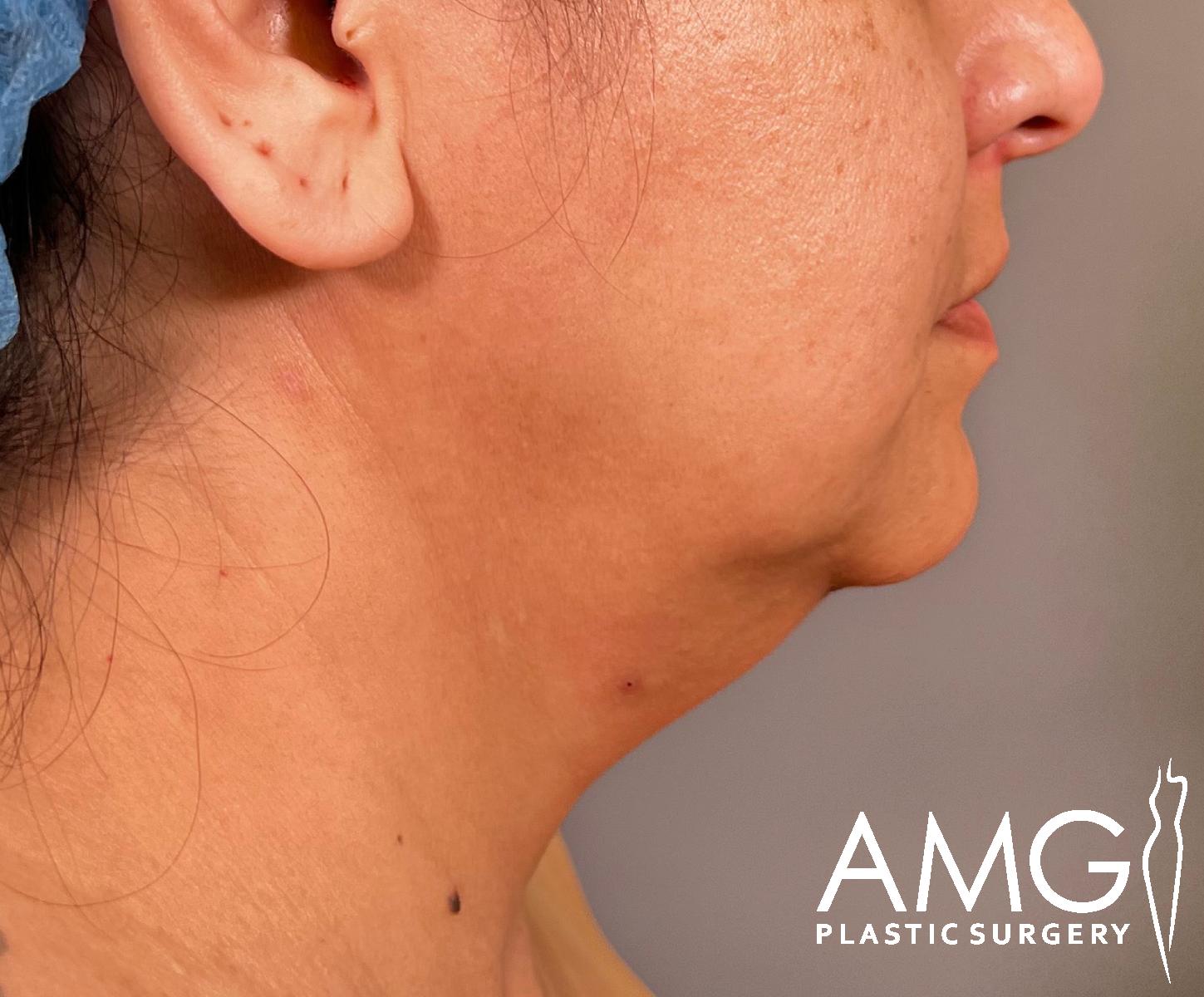 Right side view of a woman’s lower face and neck before chin liposuction at AMG Plastic Surgery in Herndon, VA