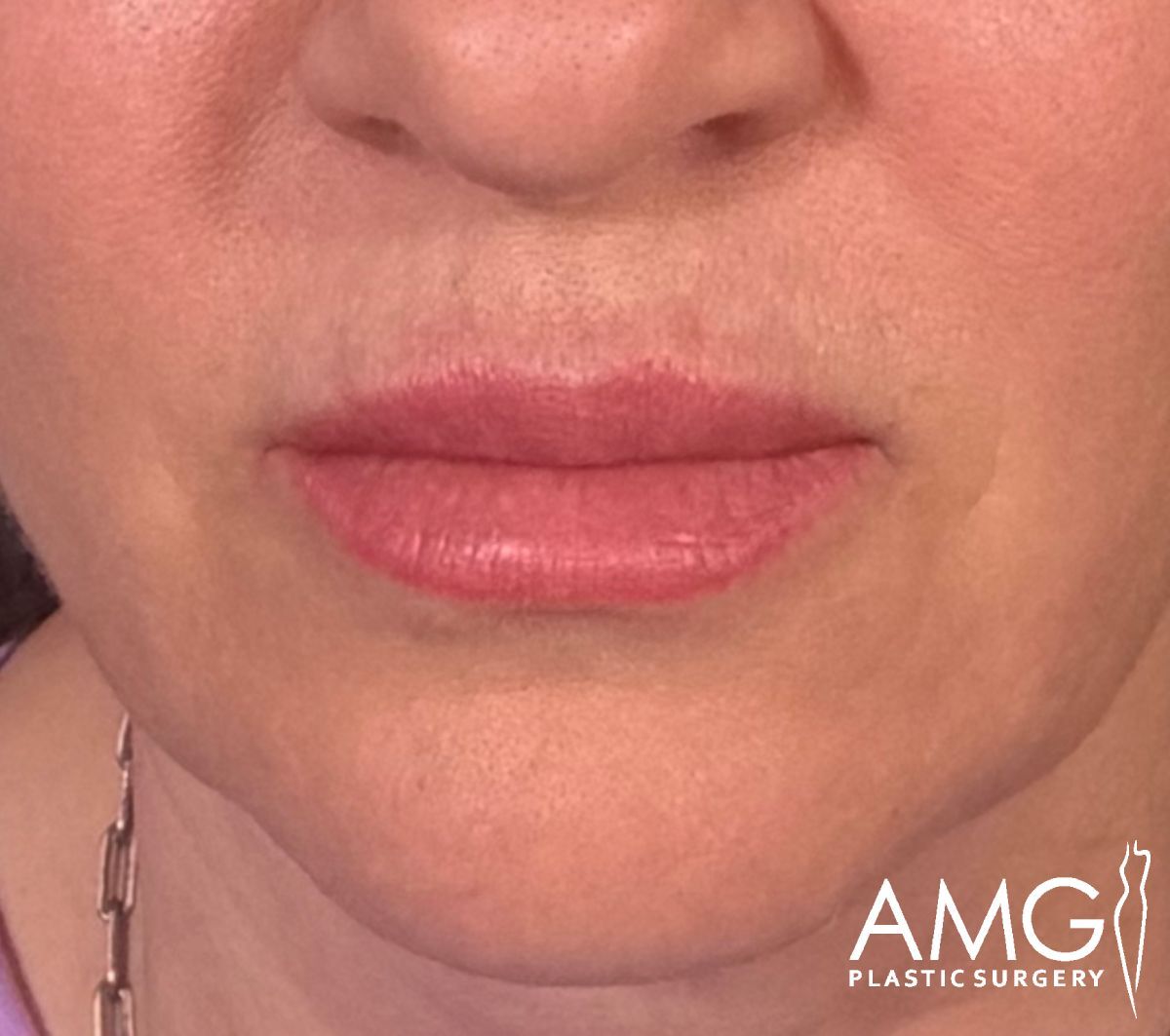 Close-up of a persons lower face showing lips with a defined, pinkish lip line. The skin appears smooth, and the person is wearing a light purple top. The image has the AMG Plastic Surgery logo in the bottom right corner.