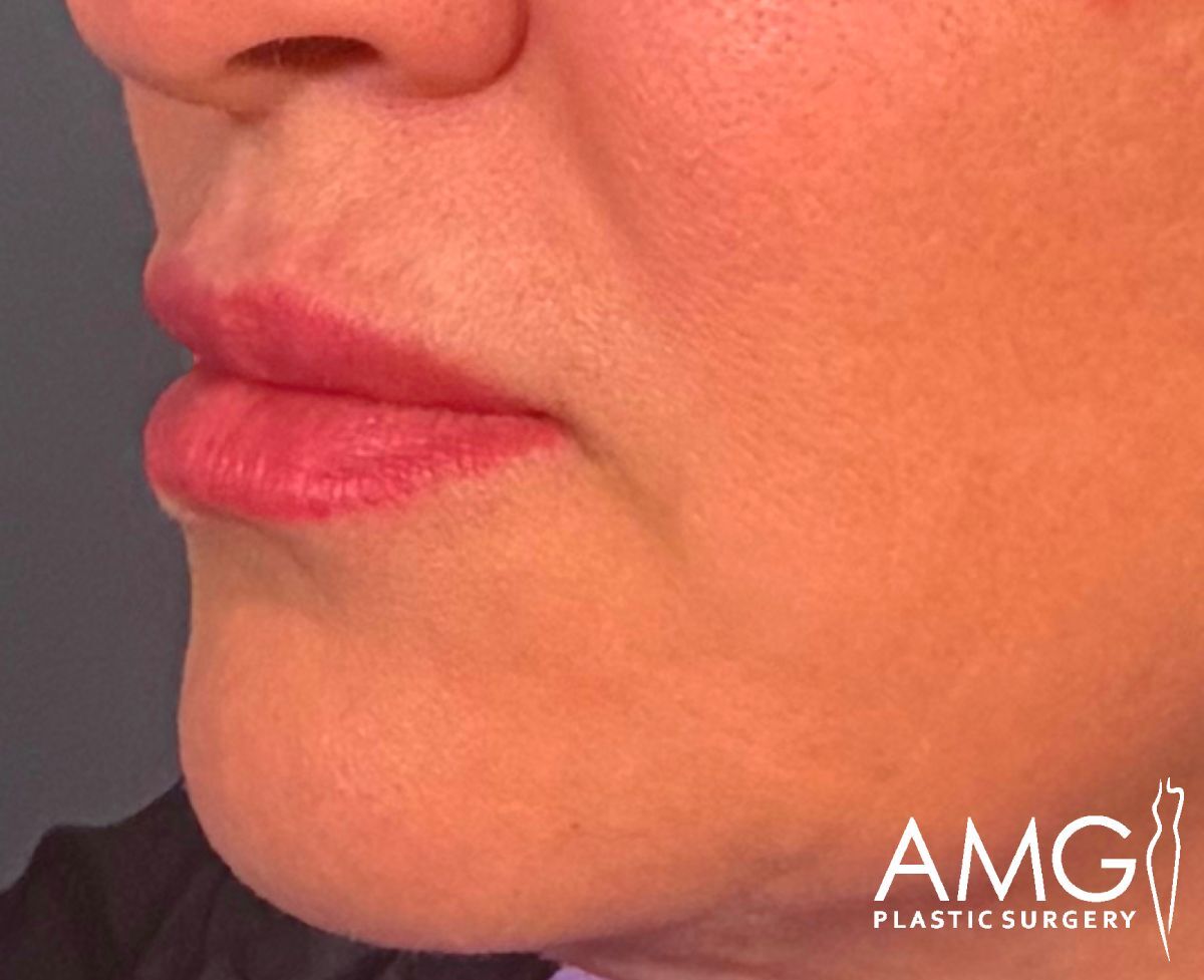 Close-up of the lower half of a persons face, highlighting smooth skin and full lips. The image has the AMG Plastic Surgery logo in the bottom right corner.