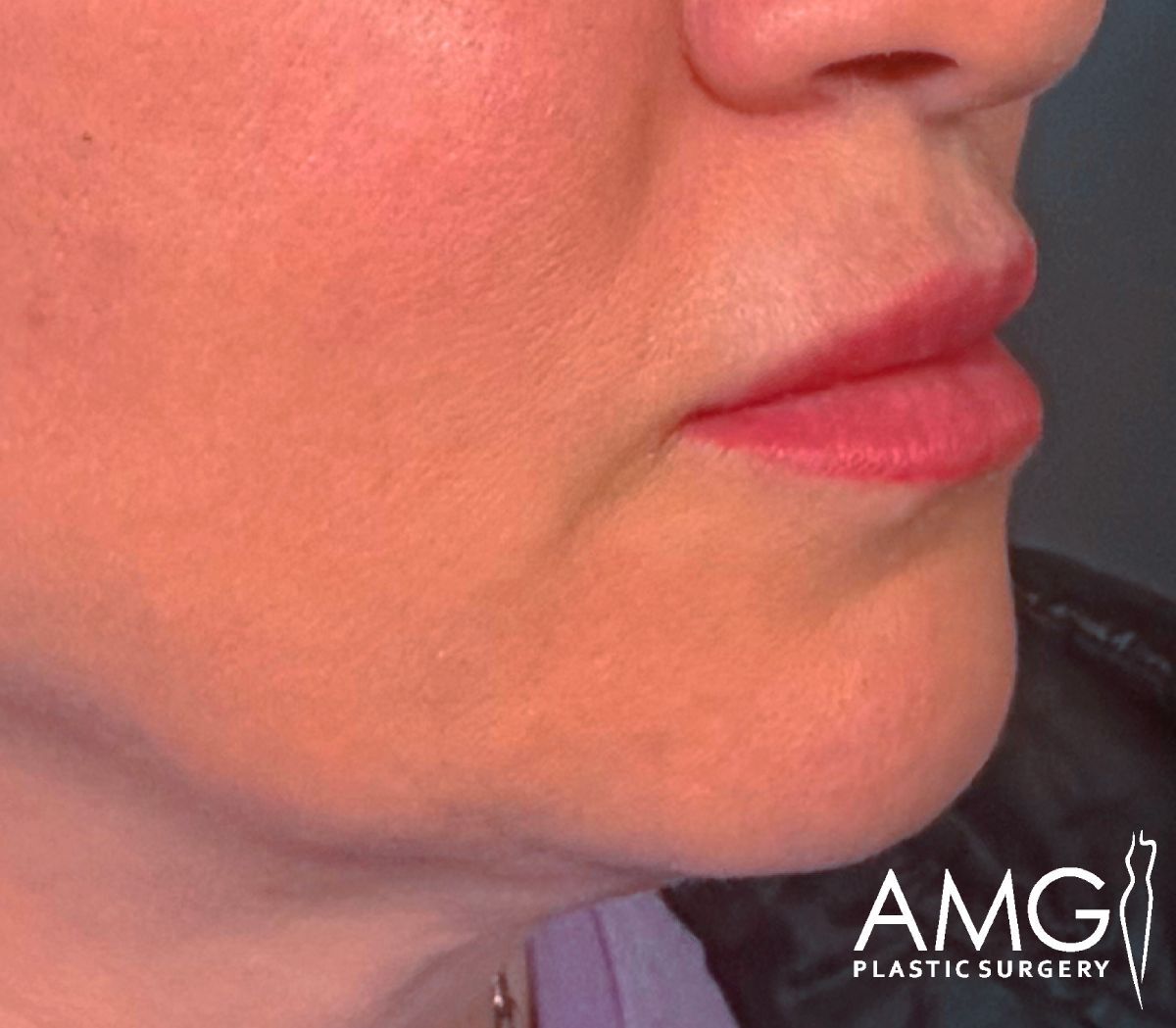 Close-up of the lower face and chin of a person with smooth, even-toned skin. The logo AMG Plastic Surgery is visible in the bottom right corner.