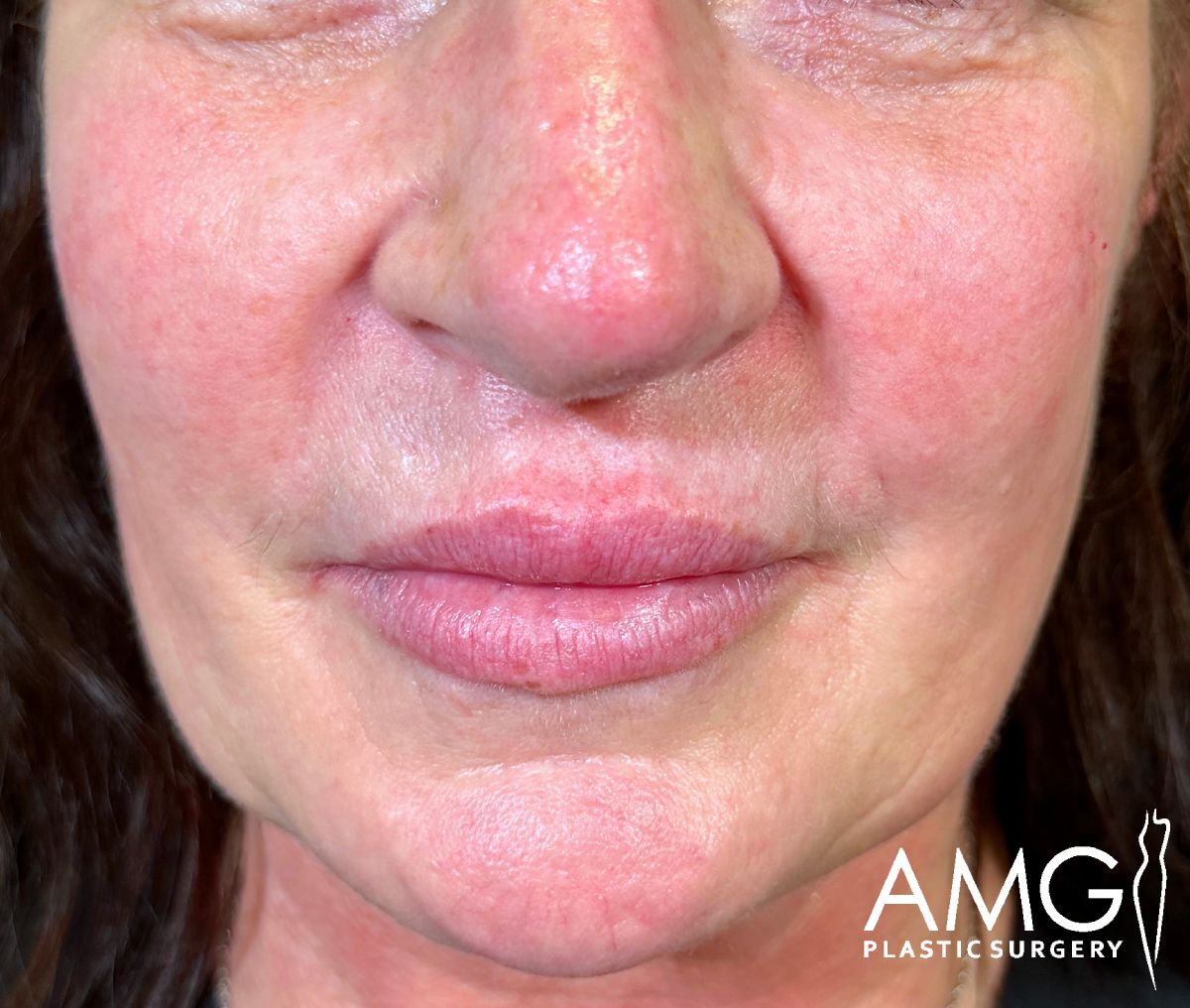 Close-up of a woman’s lower face and nose, showing pink, flushed skin and slight wrinkles. AMG Plastic Surgery logo appears in the bottom right corner.