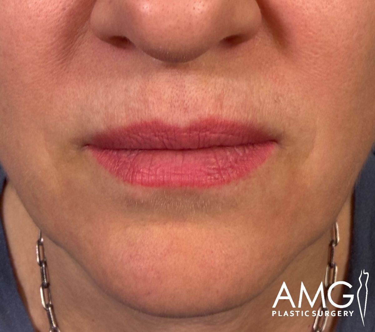 Close-up of a persons lower face and lips, showing natural lip texture and color. The person is wearing a chain necklace. AMG Plastic Surgery logo is visible in the bottom right corner.