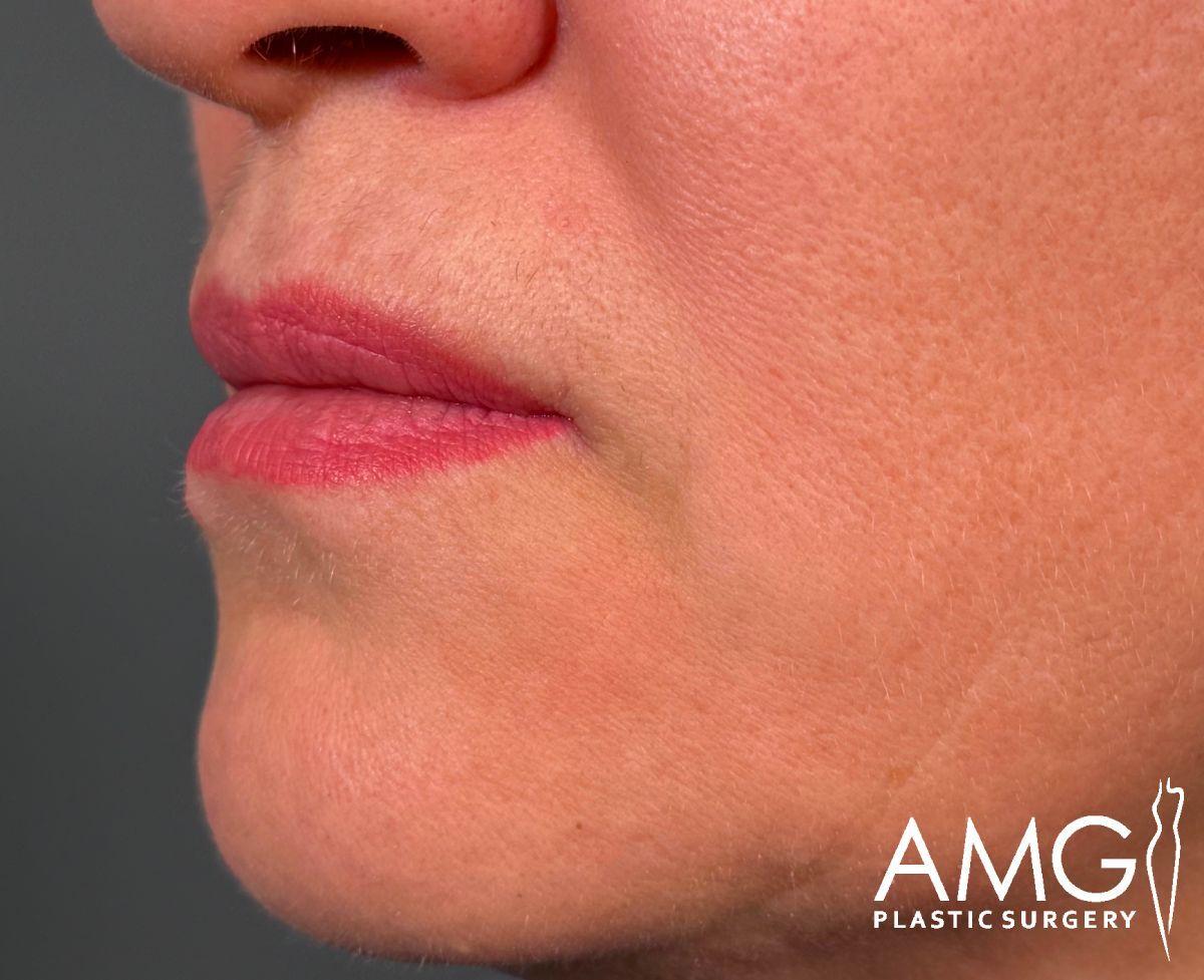 A close-up of the lower half of a persons face, focusing on the lips, chin, and cheek, with smooth skin. The AMG Plastic Surgery logo is visible in the bottom right corner.