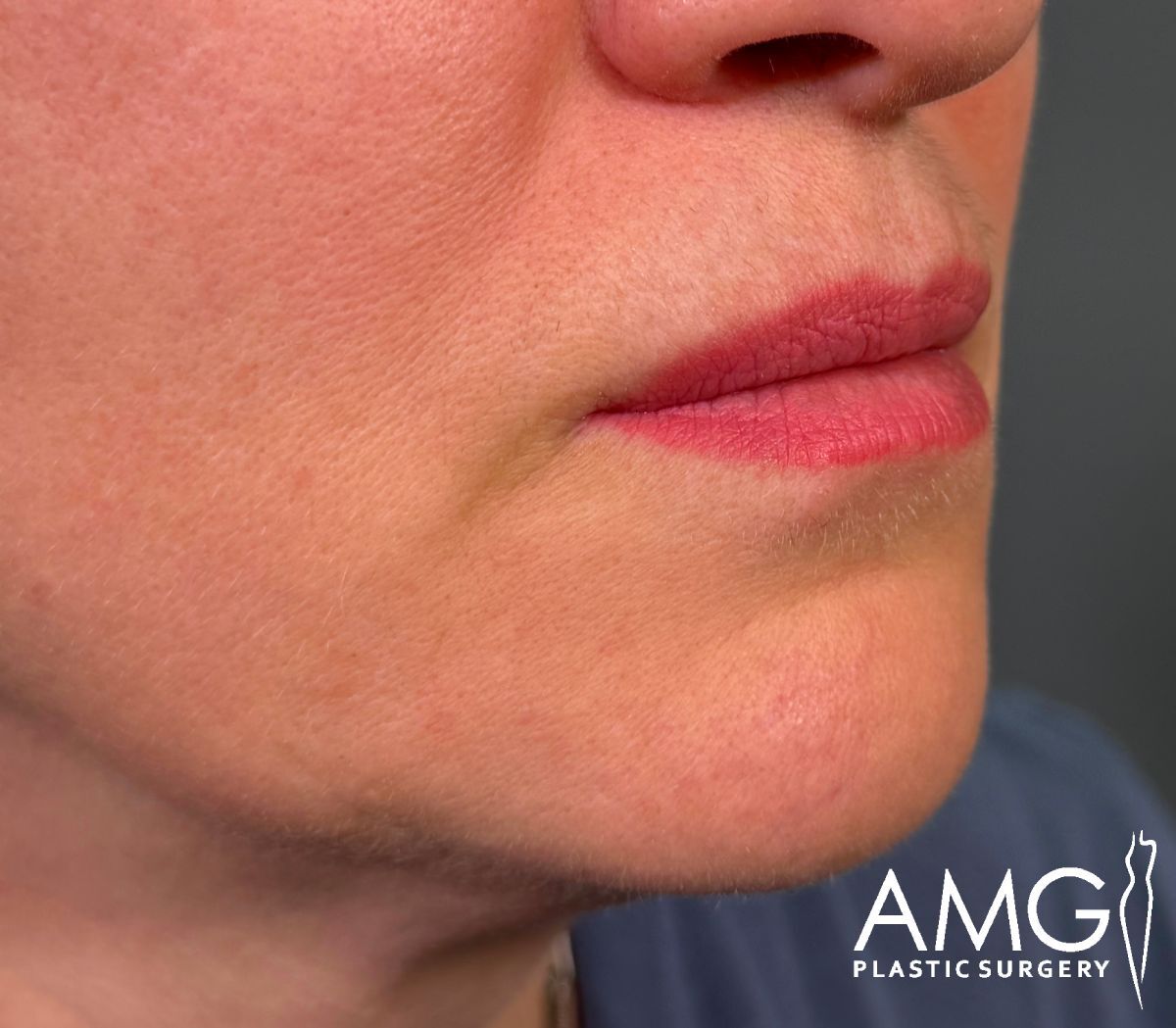Close-up of the lower face of a person with smooth skin and natural lips, showing the mouth, chin, and part of the cheek. The corner features the AMG Plastic Surgery logo.