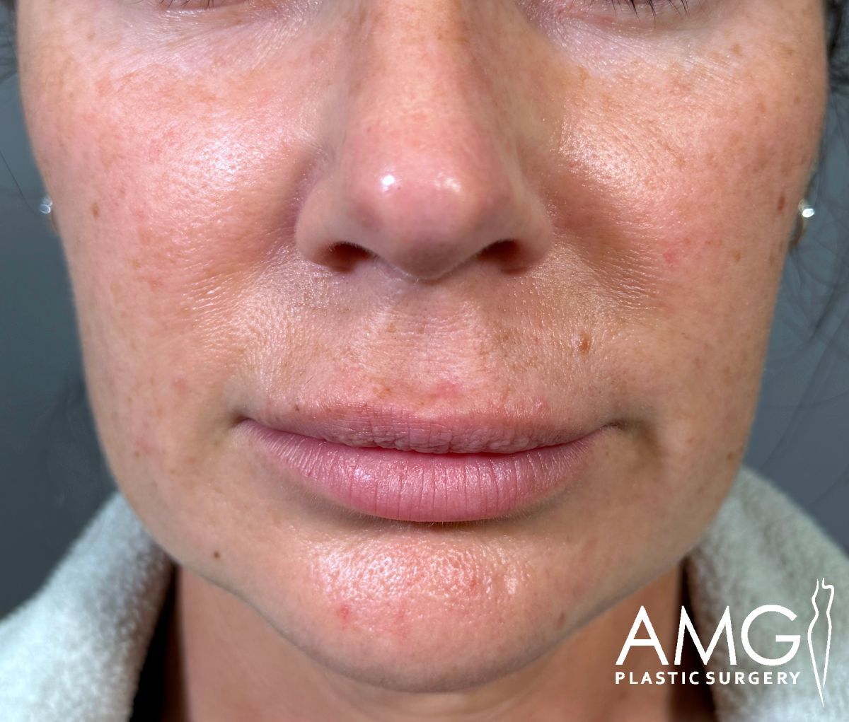 Close-up of a womans lower face showing natural skin texture, minor blemishes, and light pigmentation; lips are relaxed, with AMG Plastic Surgery logo in the bottom right corner.