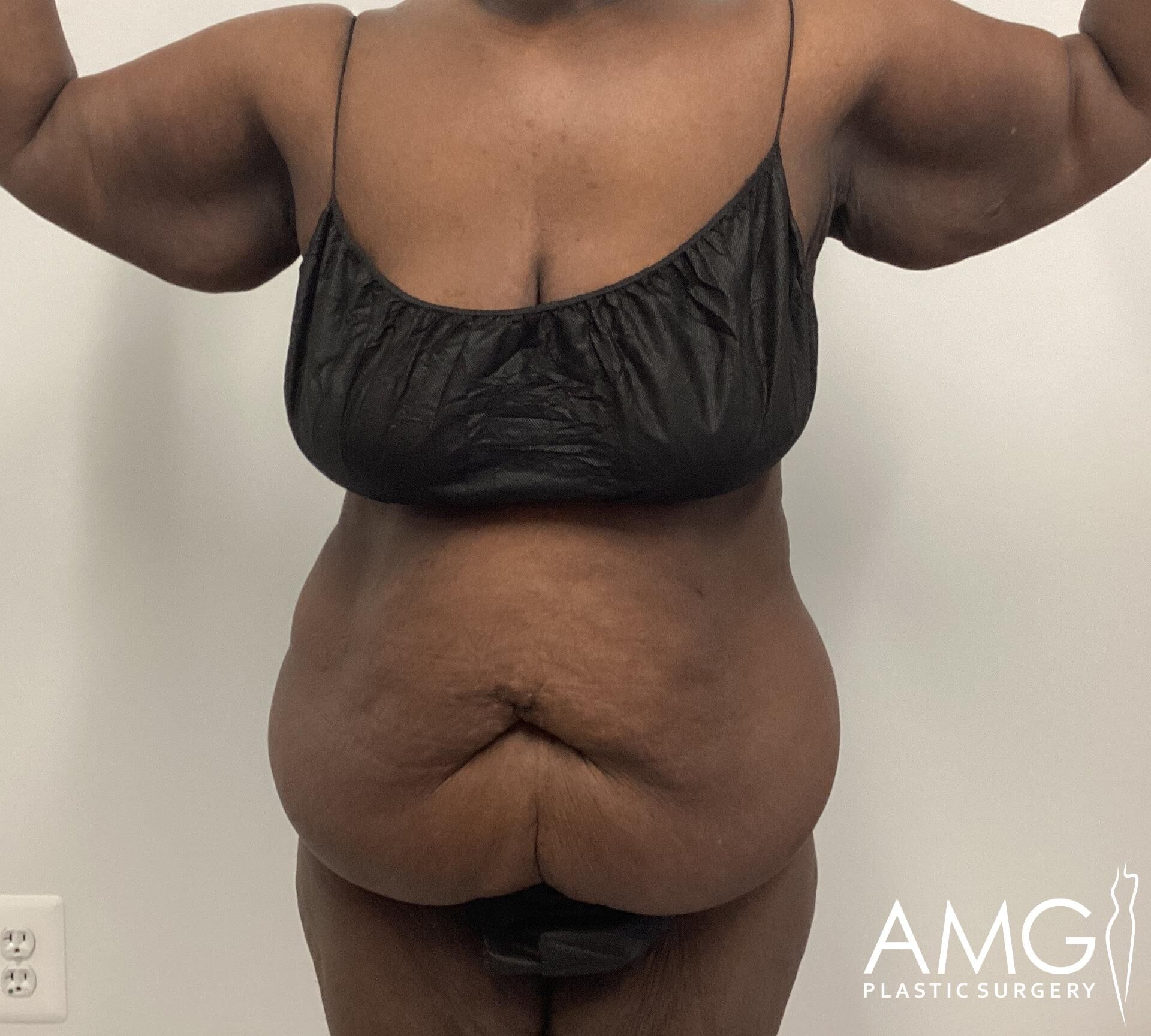 Person in black undergarments showing midsection with excess skin. Arms raised to the sides. White background with 