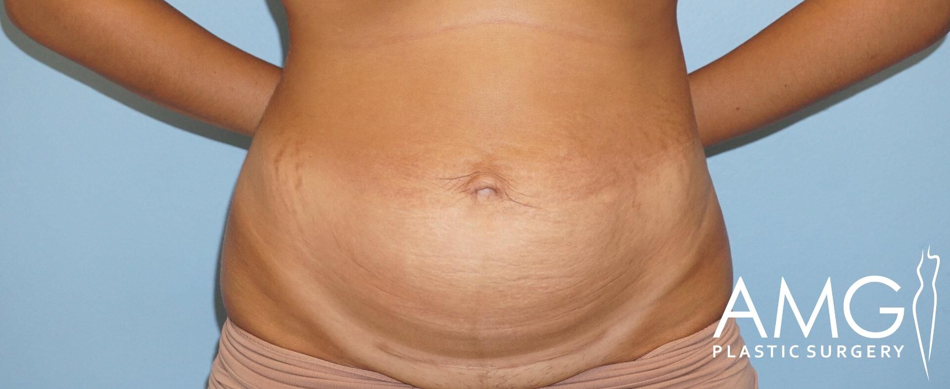 Close-up of an abdomen showing skin texture and stretch marks, with arms partially visible; 