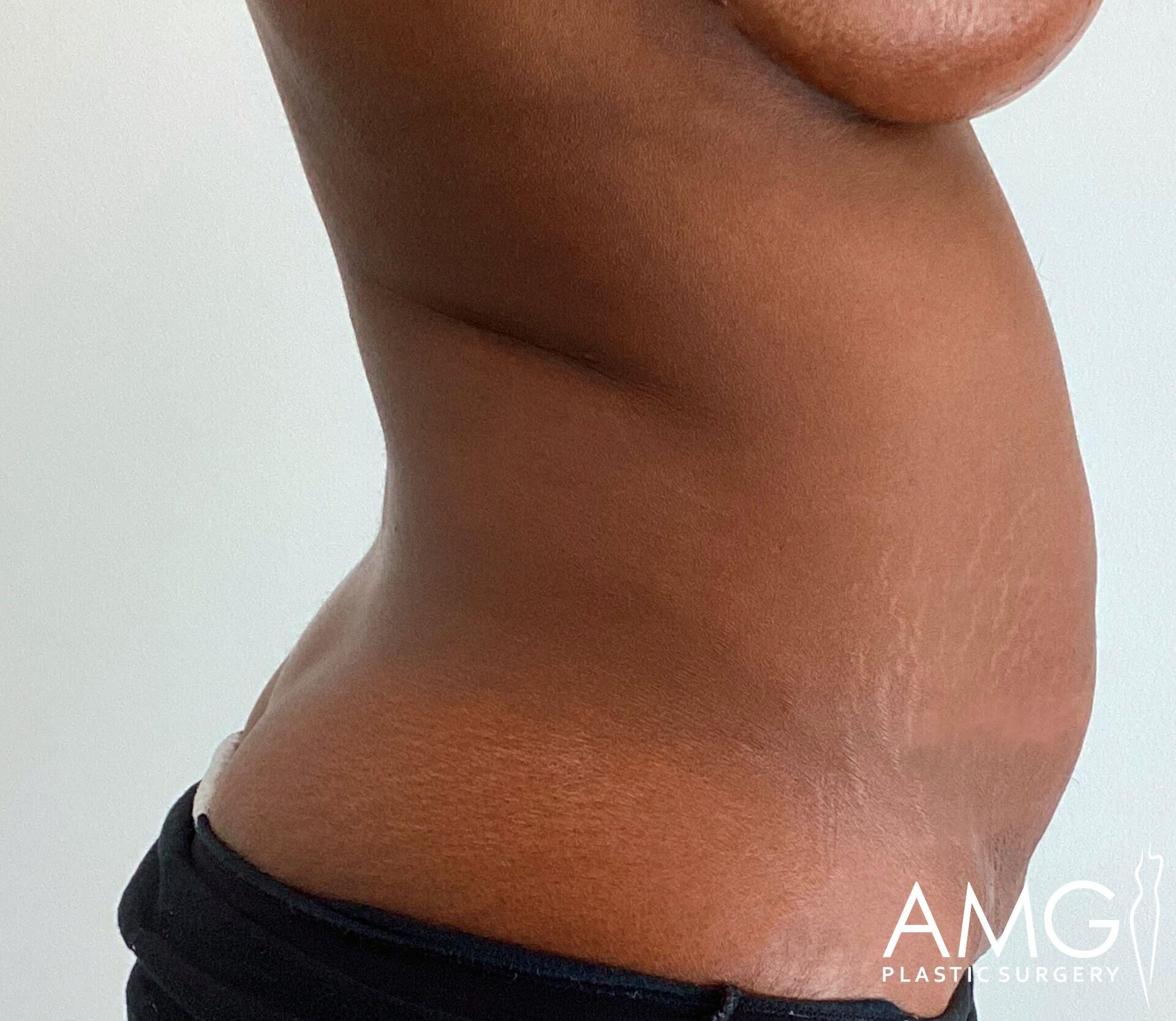 Close-up of a person's side profile showing abdomen and waist, with visible stretch marks. The person is wearing dark pants. The logo "AMG Plastic Surgery" is at the bottom right.