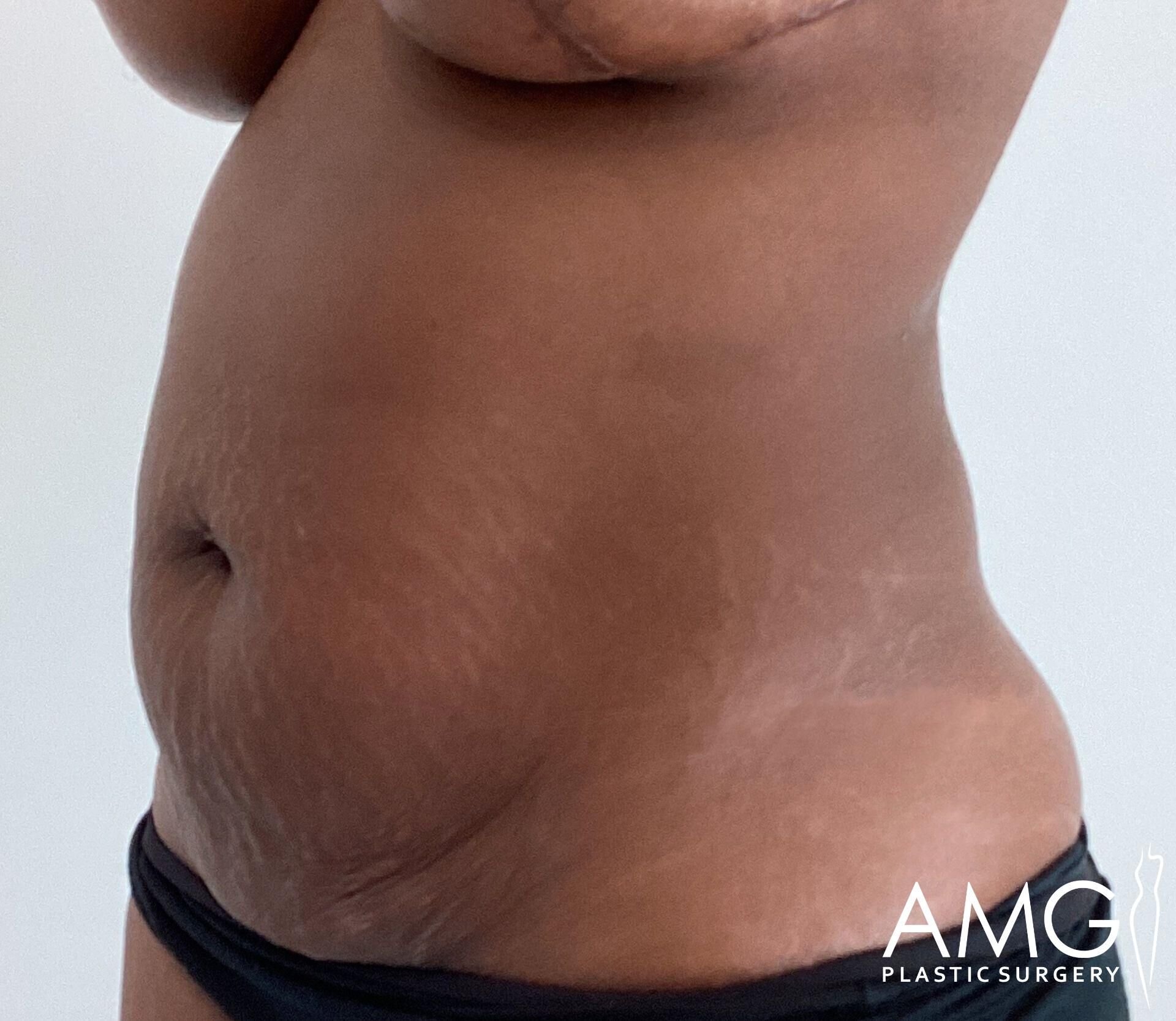 Side view of a person’s abdomen and hip wearing black undergarments, showing natural skin texture and contours.