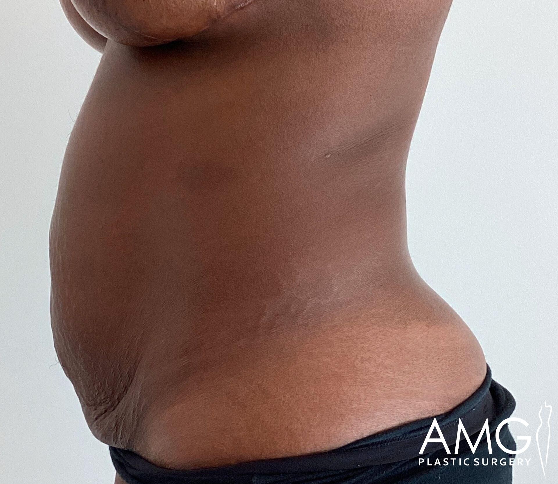 Person's torso with skin folds, viewed from the side. They are wearing dark pants. Logo in the bottom right corner reads "AMG Plastic Surgery.