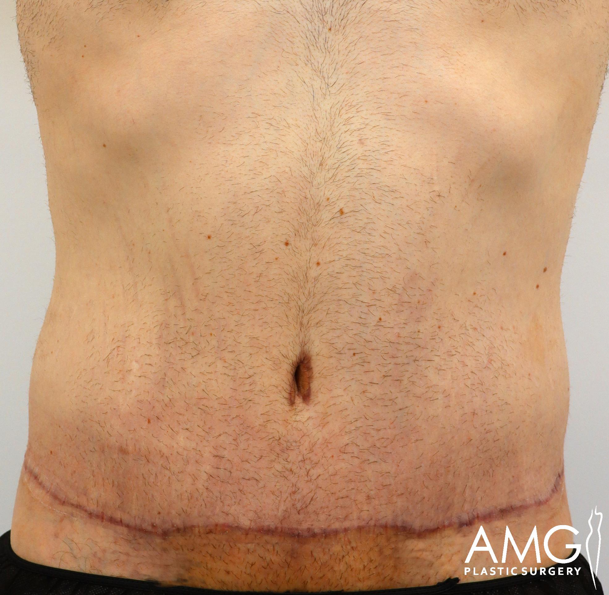 Close-up of a person's abdomen showing a healed surgical scar running horizontally along the lower stomach. The skin appears healthy with visible hair and a logo for AMG Plastic Surgery is present.