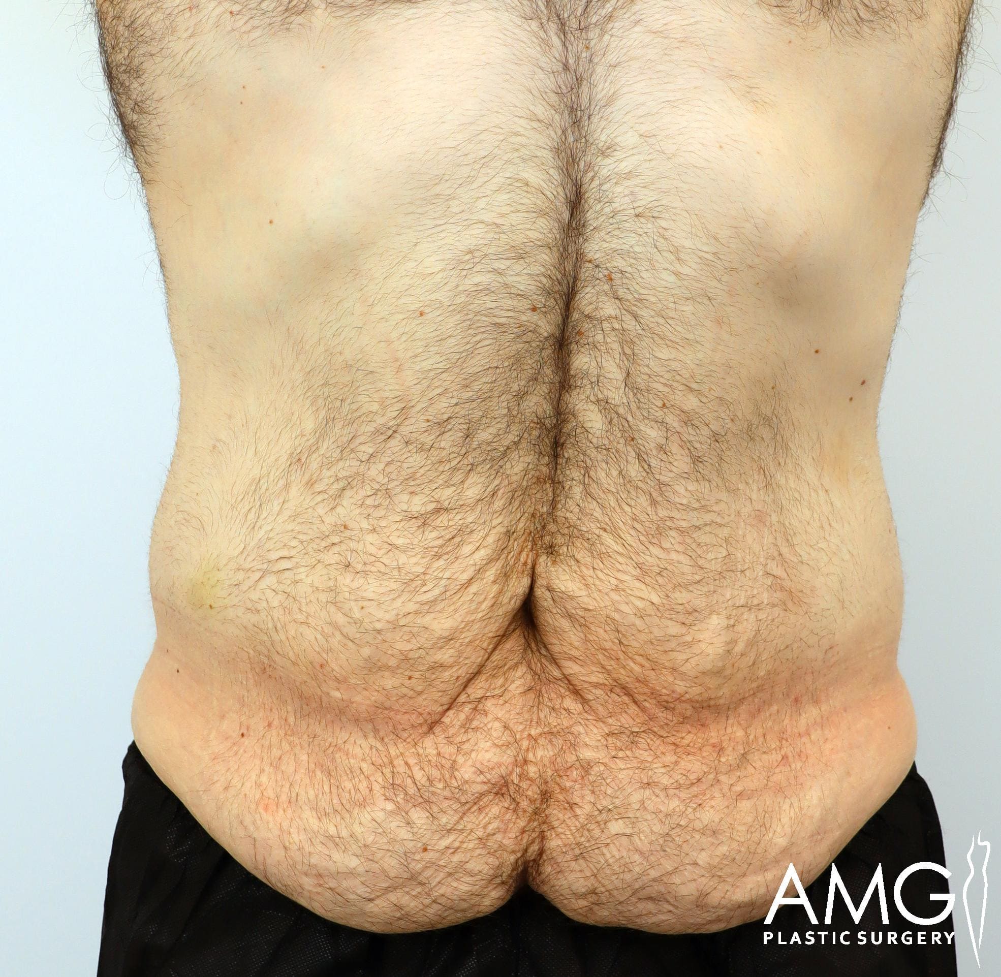 Close-up of a person’s lower back showing skin folds and body hair. Logo in the bottom right corner reads 