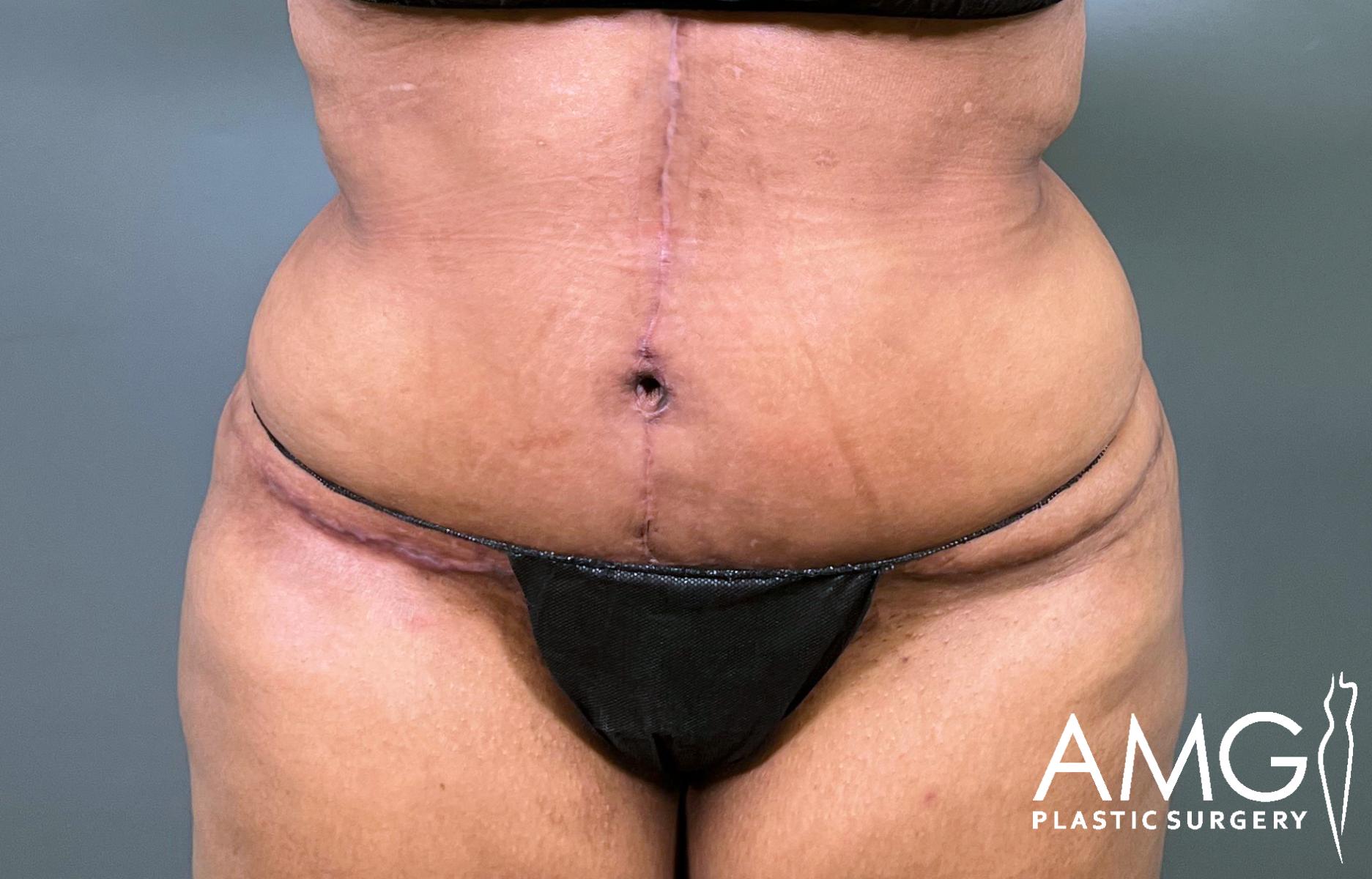 A person’s midsection showing scars from recent plastic surgery, including a horizontal scar above the hips and a vertical scar from the chest to the navel; AMG Plastic Surgery logo is in the lower right corner.