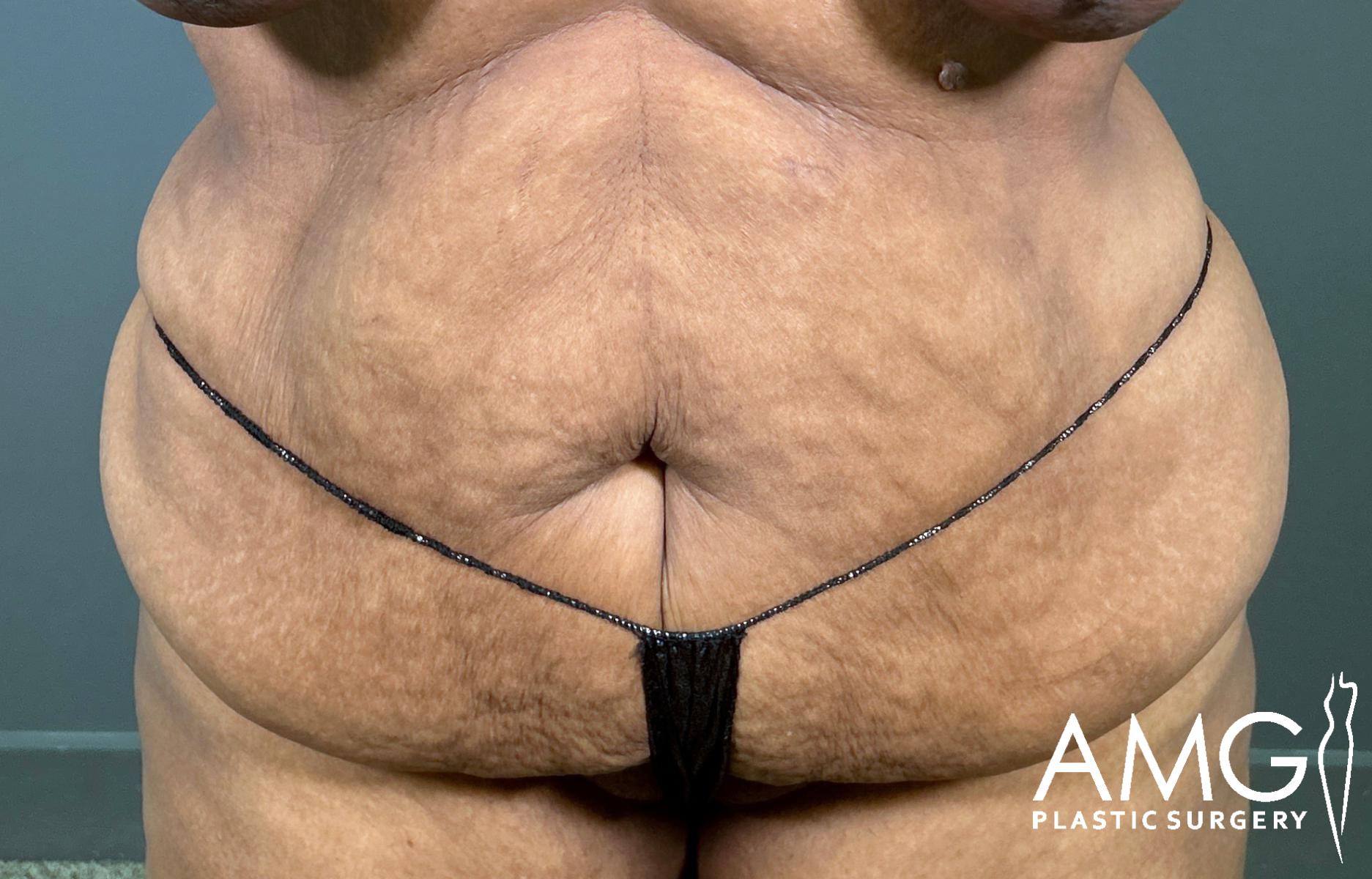 A close-up of a person’s lower abdomen with loose, excess skin, wearing a minimal black undergarment. The AMG Plastic Surgery logo is visible in the bottom right corner.