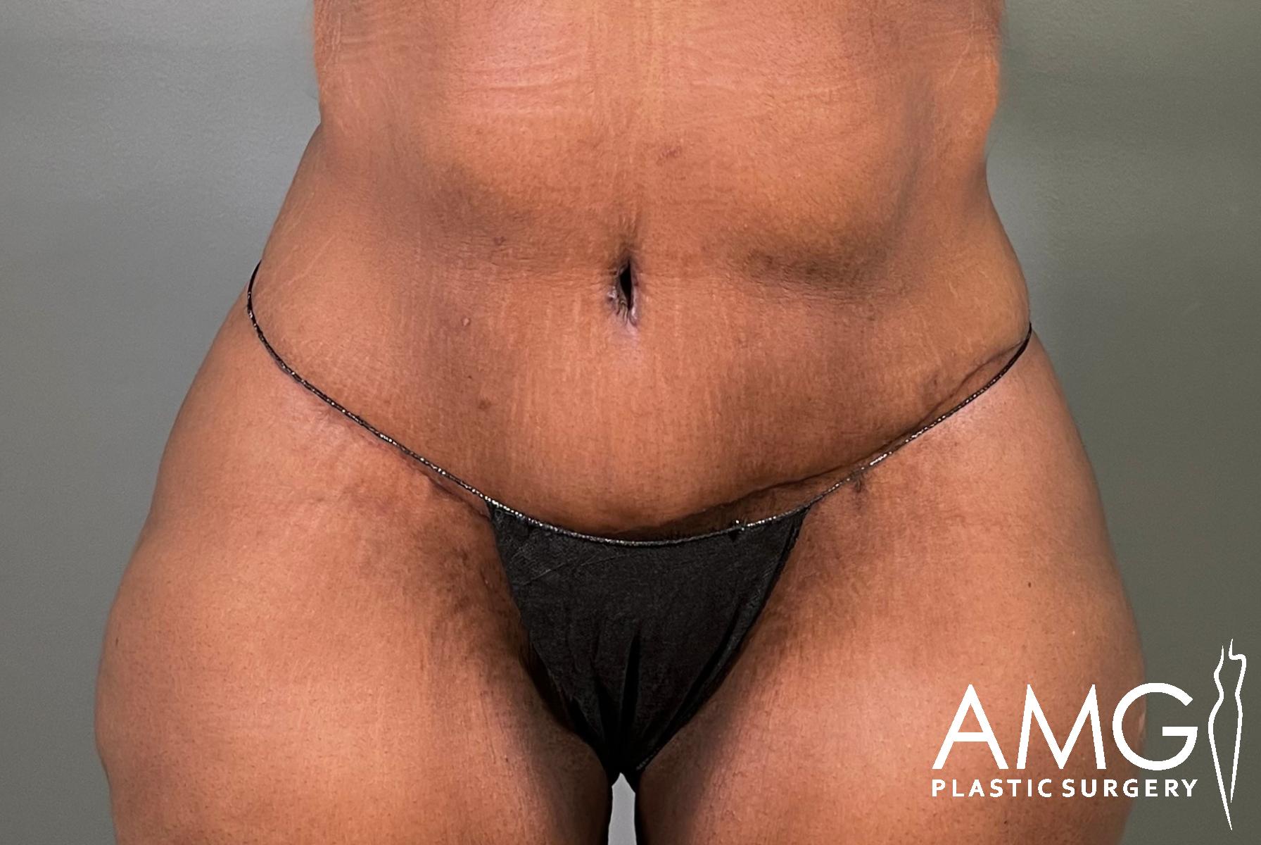 A close-up view of a person’s midsection, showing their abdomen and upper thighs. The person is wearing a black undergarment, and the logo AMG Plastic Surgery appears in the lower right corner.