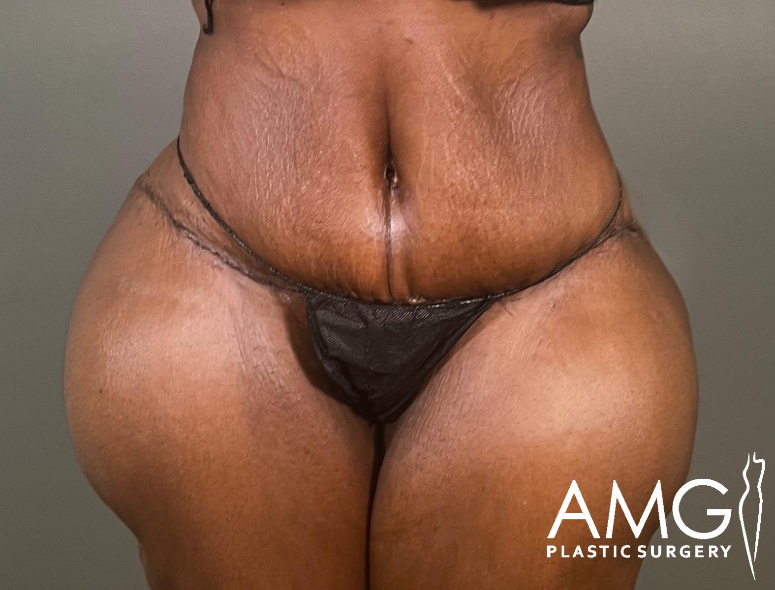 A person with visible surgical scars on their abdomen and hips stands against a plain background, wearing black underwear. The logo AMG Plastic Surgery appears in the lower right corner.