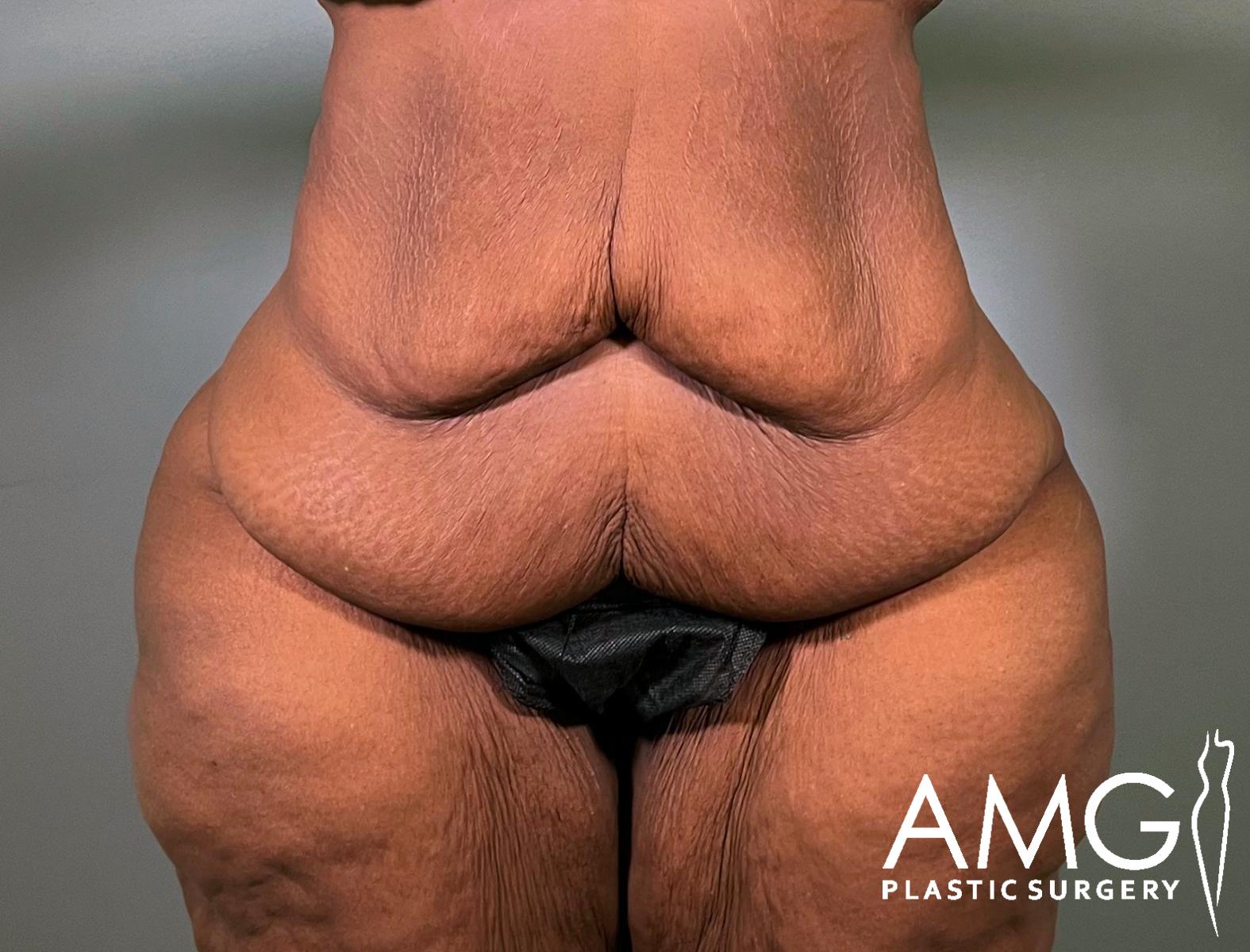 A close-up of a persons abdomen and upper thighs with loose, sagging skin. The person is wearing black underwear. The image features the AMG Plastic Surgery logo in the lower right corner.