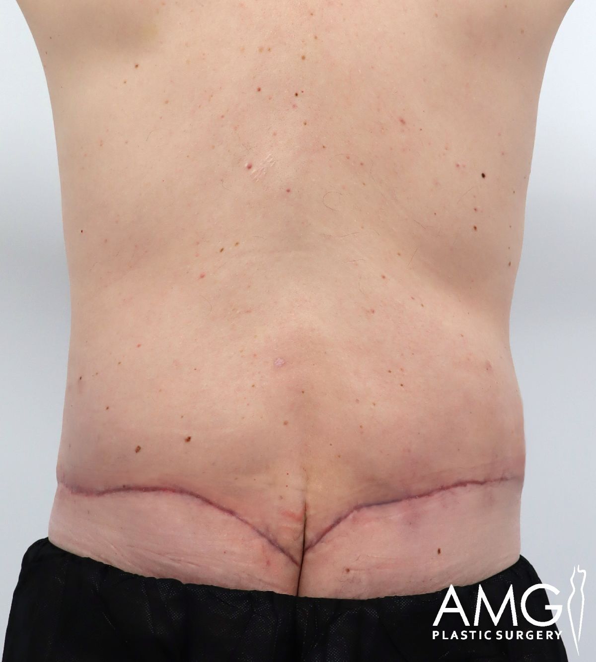 A persons lower back and waist showing a healing surgical scar from a body contouring procedure, with AMG Plastic Surgery logo in the bottom right corner.