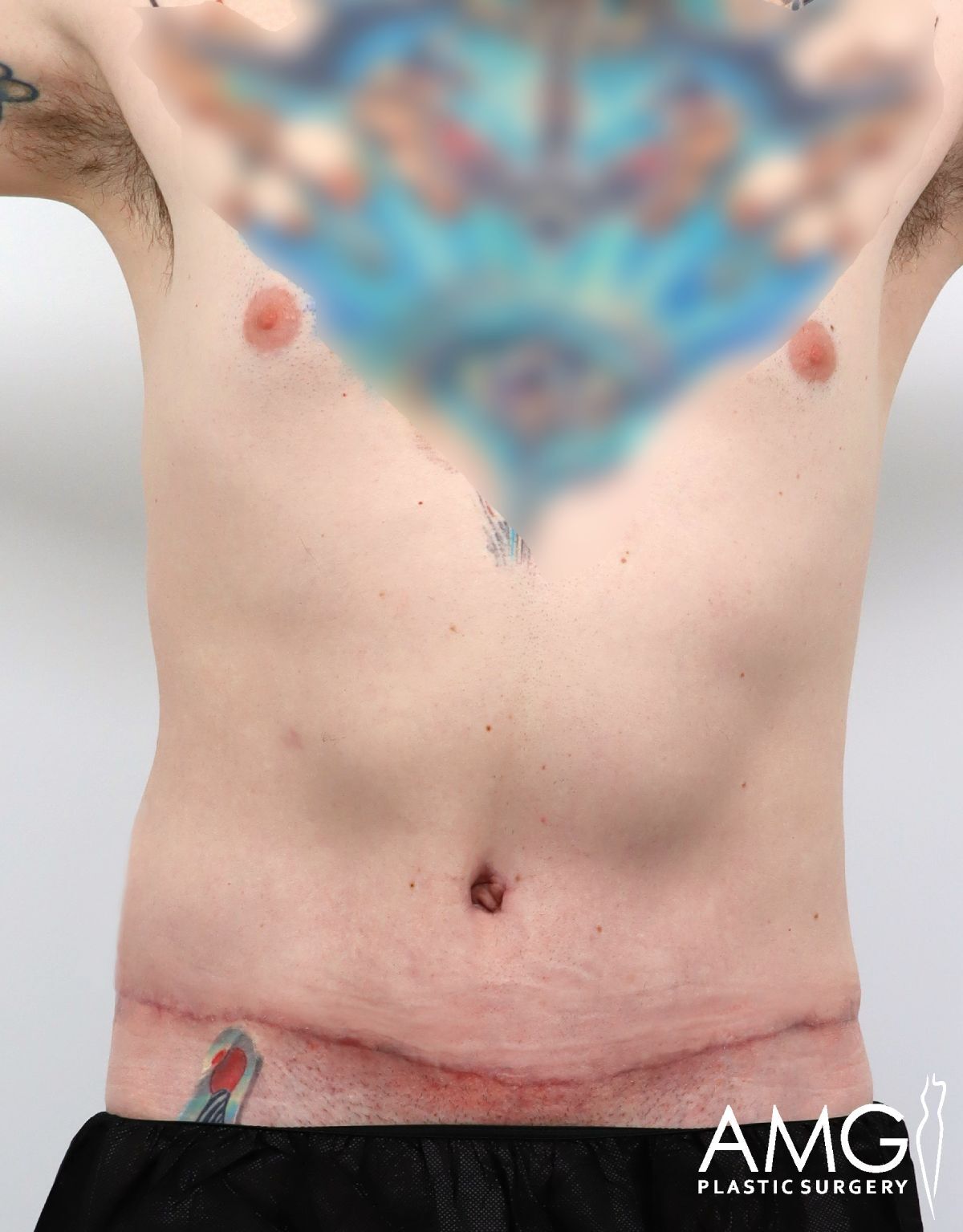A person’s bare chest and abdomen showing a healed horizontal surgical scar below the navel and faint tattoos; the chest tattoo is blurred. AMG Plastic Surgery logo appears in the bottom right corner.