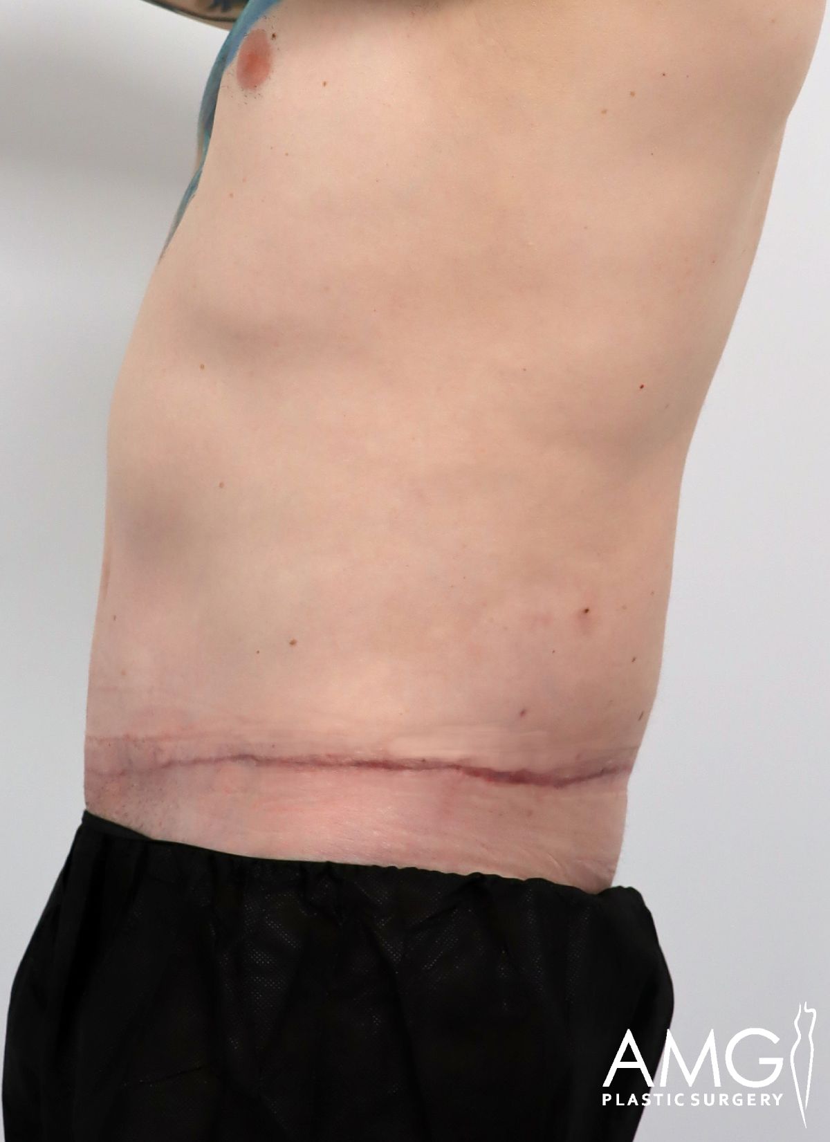 A person’s torso in profile shows a healing scar running horizontally across the lower abdomen, likely from surgery. They are wearing black pants. The AMG Plastic Surgery logo appears in the bottom right corner.