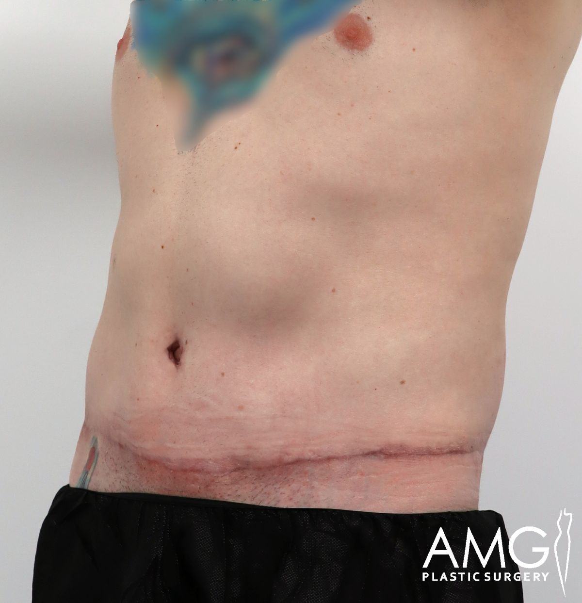 A persons bare torso from the side, showing a horizontal surgical scar across the lower abdomen. The person is wearing black pants, with the AMG Plastic Surgery logo in the corner.
