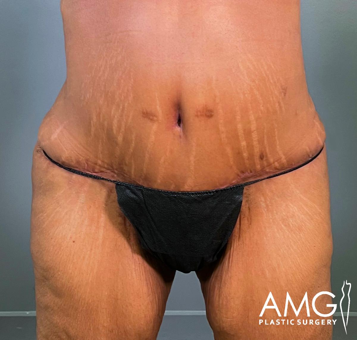 A person’s midsection showing a healing scar from tummy tuck surgery, with visible stretch marks and wearing black underwear. The AMG Plastic Surgery logo is in the lower right corner.