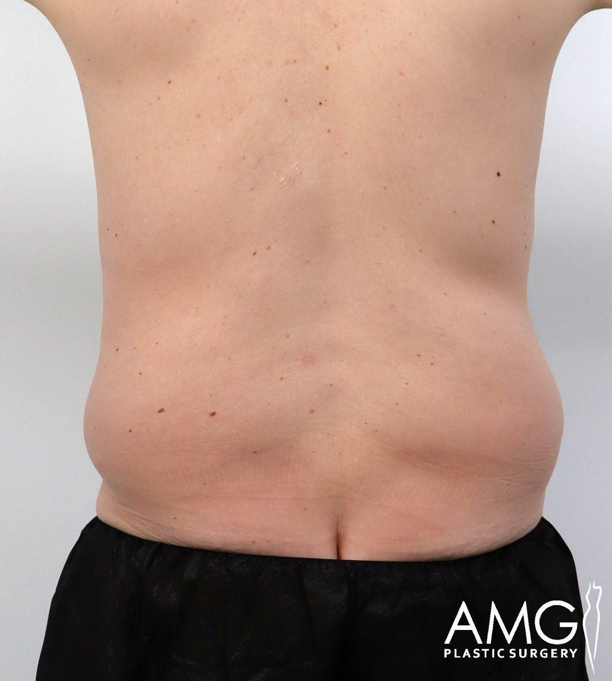 A person’s lower back and waist are shown, displaying visible fat deposits on the sides. The individual is standing, and the logo “AMG Plastic Surgery” appears in the lower right corner.