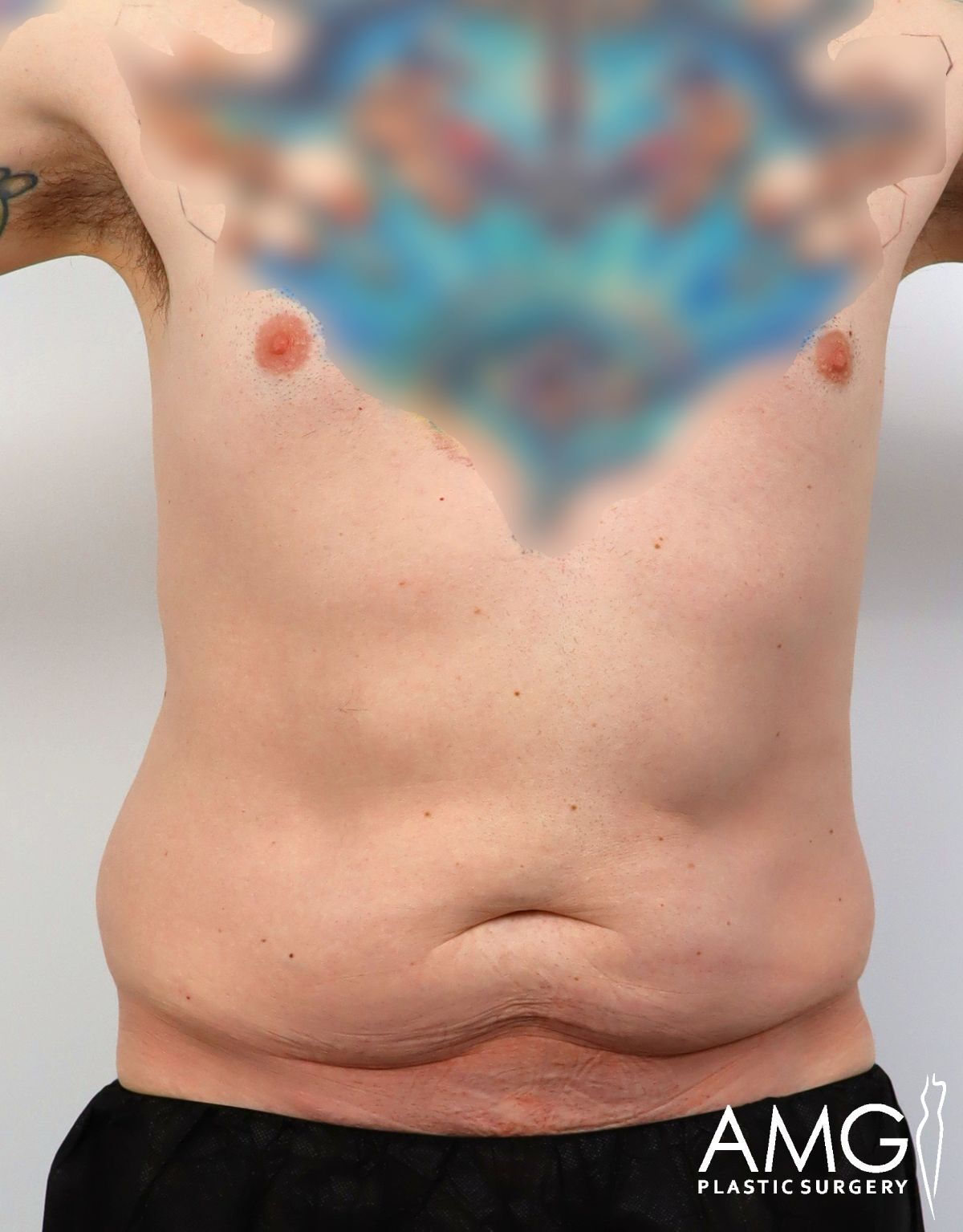 A person’s bare torso with some loose skin and minor abdominal fat. The chest area is partially blurred, and the image is watermarked with the AMG Plastic Surgery logo in the lower right corner.