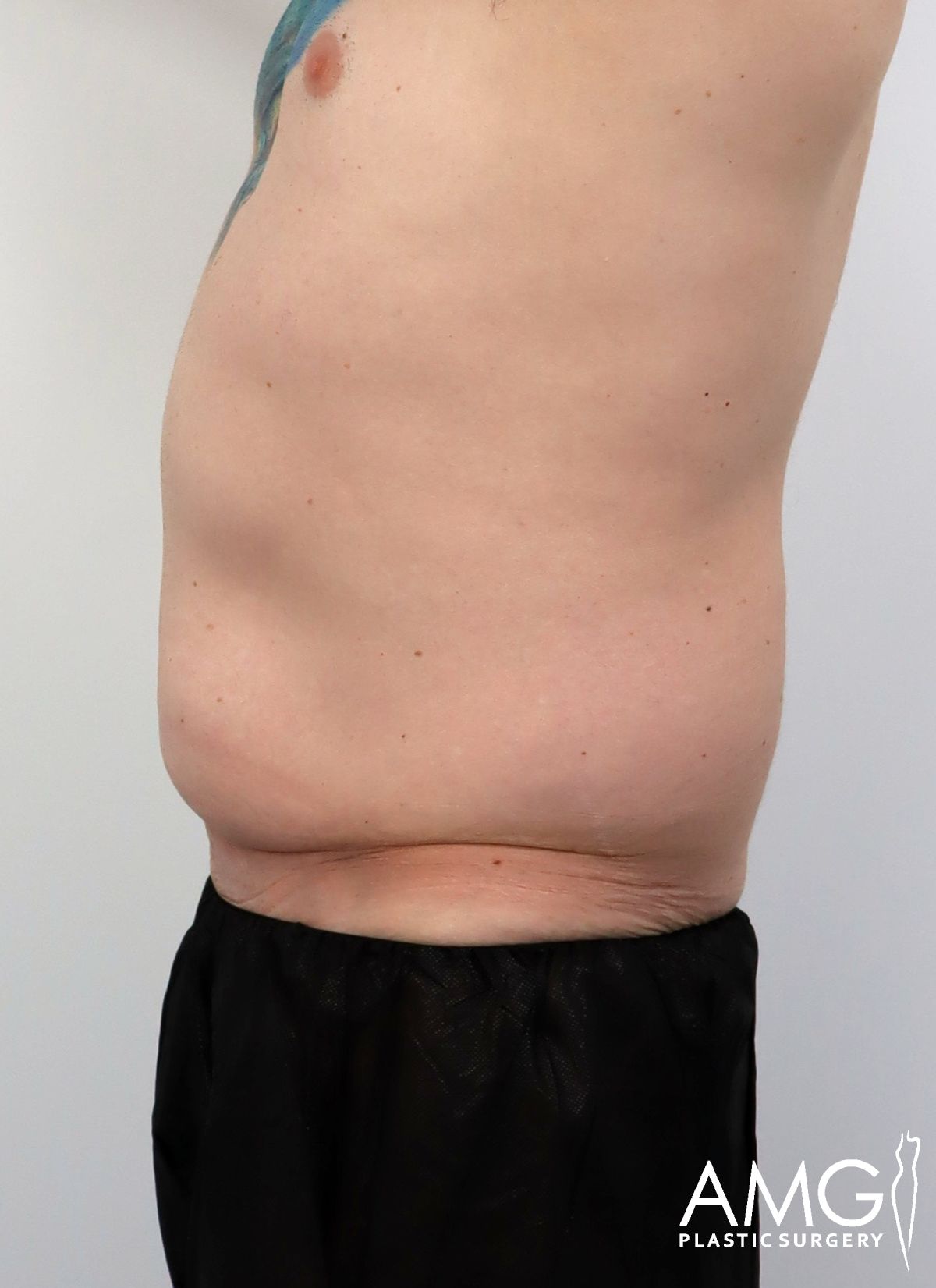 Side view of an adult persons bare midsection with visible abdominal fat and loose skin; the individual is wearing black pants. The AMG Plastic Surgery logo is visible in the bottom right corner.