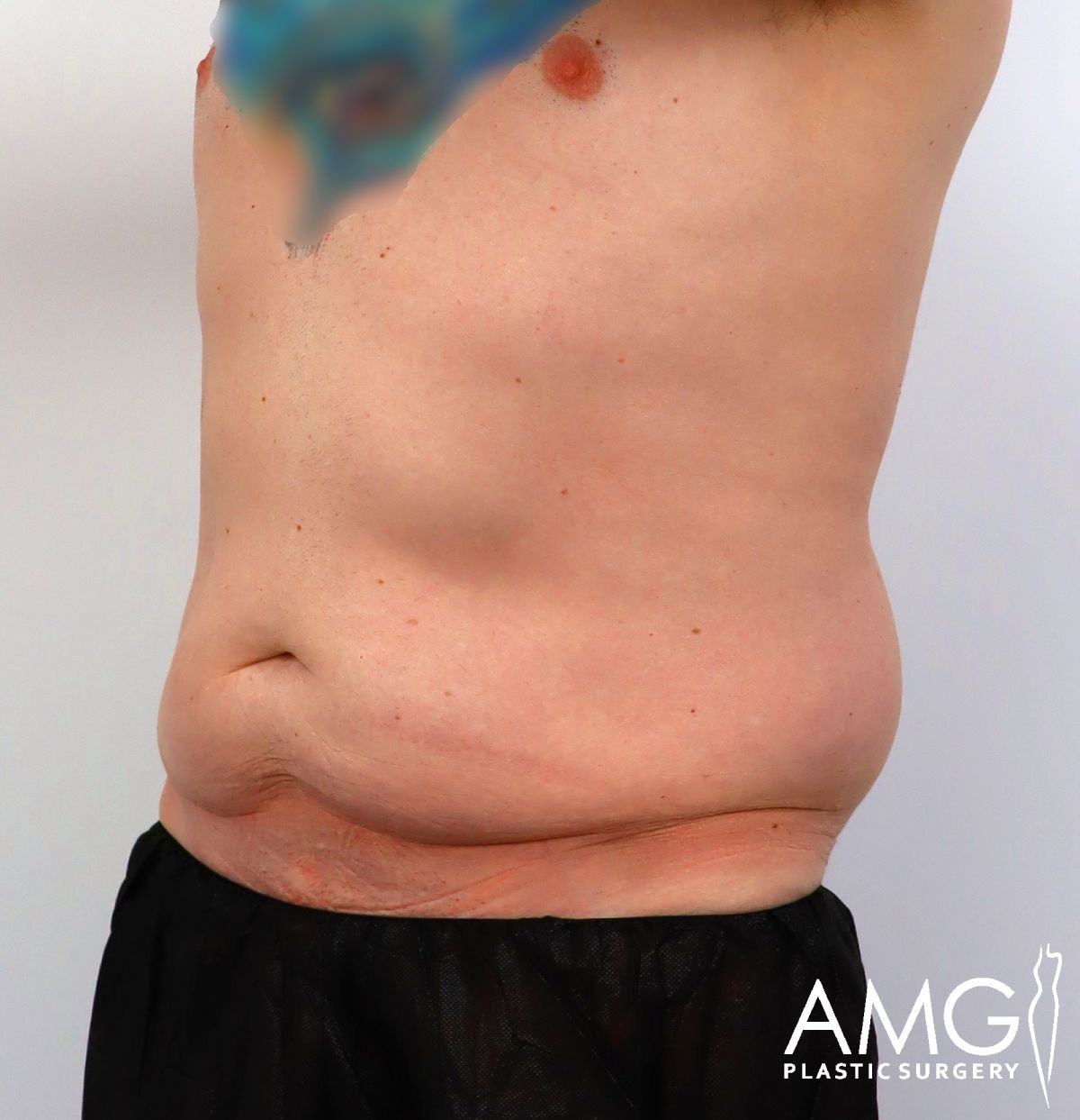 A person’s torso from a side view showing loose skin and excess fat around the abdomen. The person is wearing black pants. The AMG Plastic Surgery logo appears in the bottom right corner.