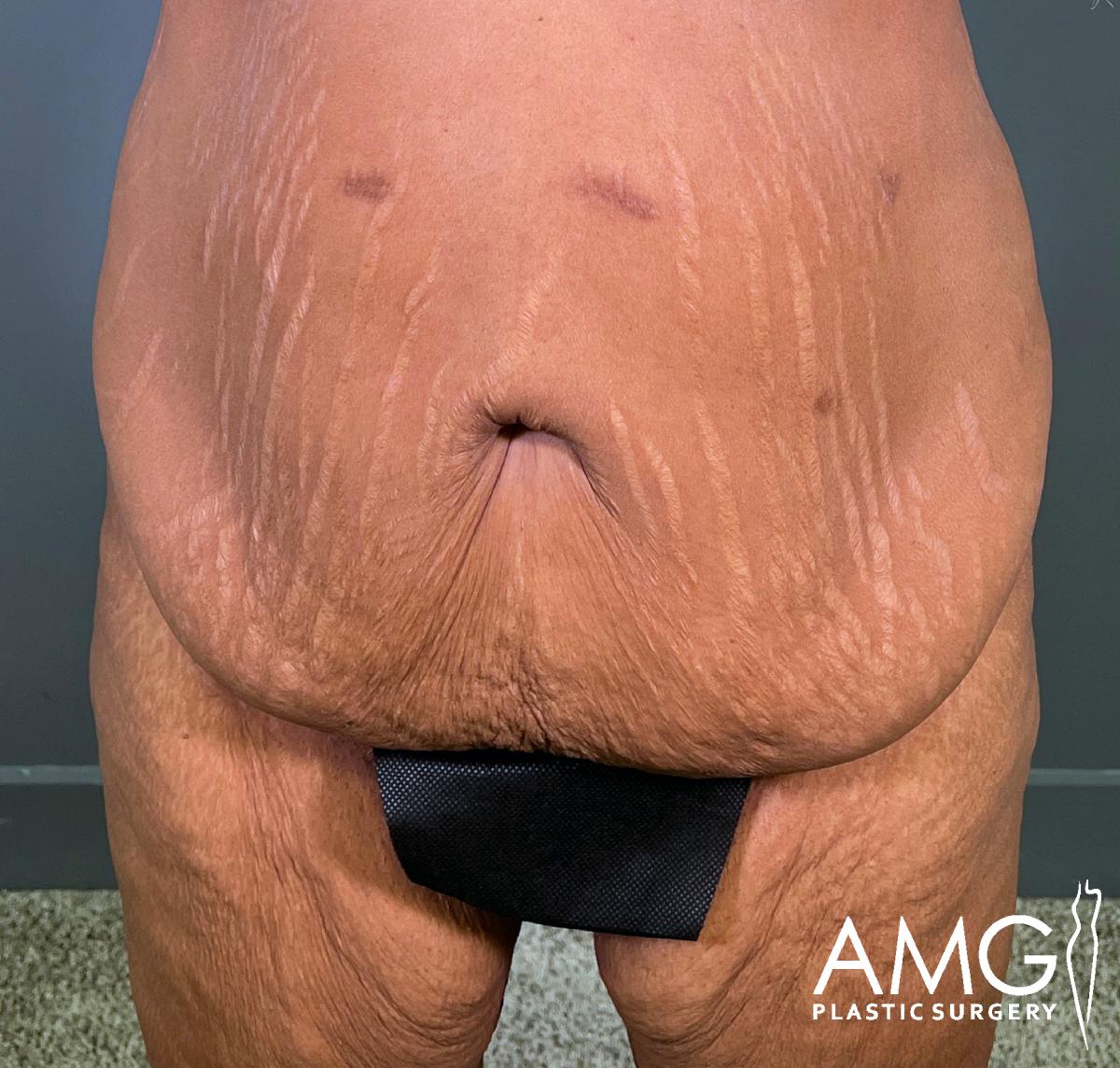 A close-up of a person’s lower abdomen and upper thighs, showing loose skin, stretch marks, and a black rectangle covering the genital area. AMG Plastic Surgery logo is visible in the bottom right corner.