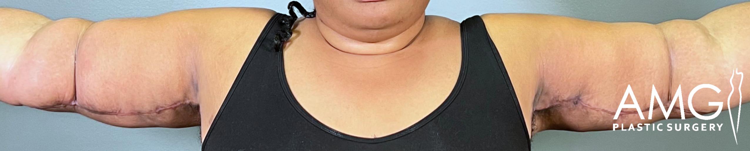 Frontal view following arm lift procedure, arms raised, showing tighter skin and a more refined upper arm silhouette, AMG Plastic Surgery.