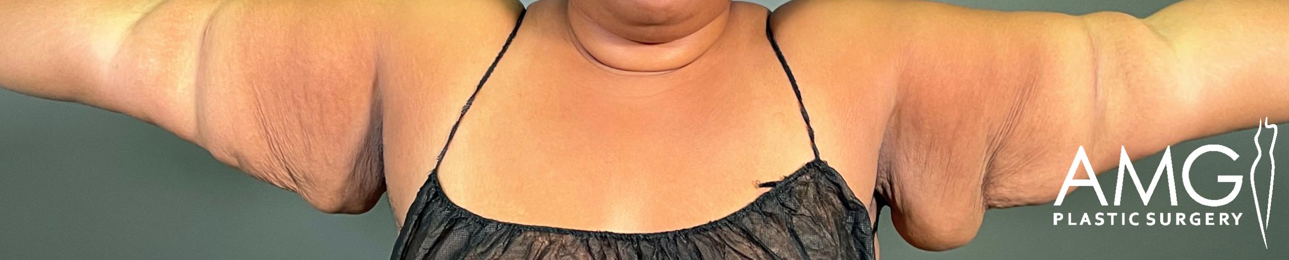 Frontal view of a patient’s upper arms prior to brachioplasty, with arms elevated, highlighting loose skin and diminished definition, AMG Plastic Surgery.