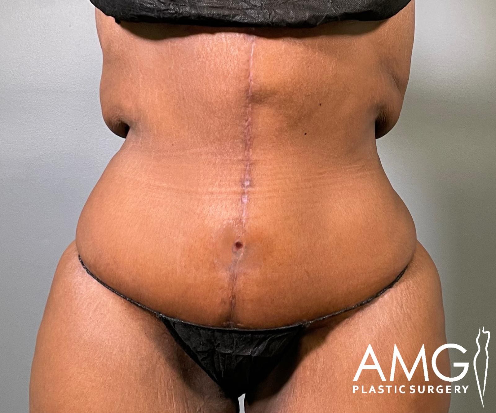 Front view of a woman's abdomen after fleur-de-lis tummy tuck showing a flatter, more contoured abdomen with a visible vertical scar, AMG Plastic Surgery.