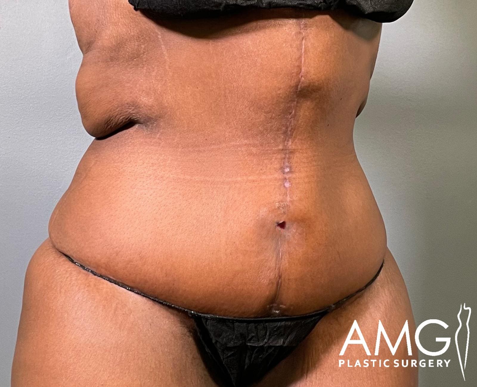Right oblique view of a woman's abdomen after fleur-de-lis tummy tuck showing a flatter, more contoured abdomen with a visible vertical scar, AMG Plastic Surgery.