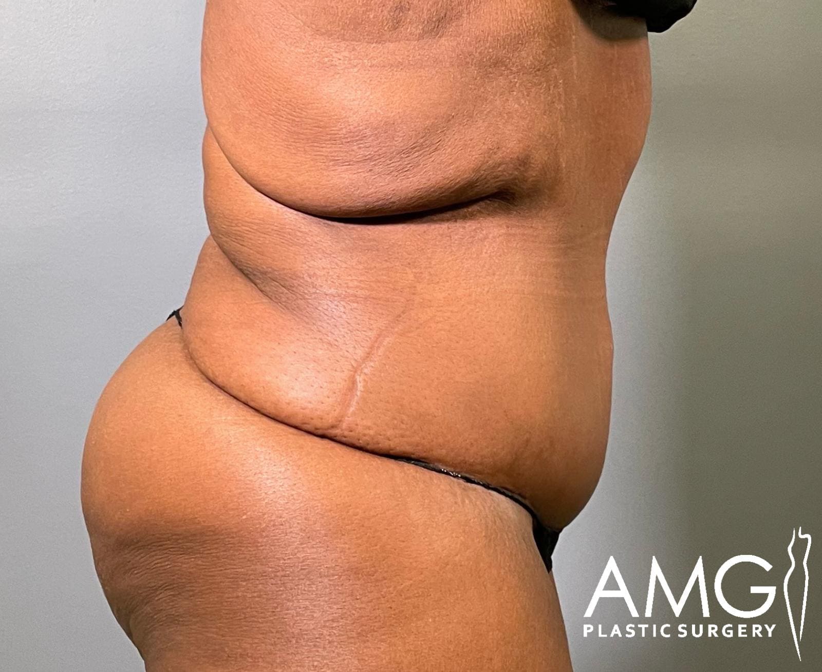Right view of a woman's abdomen after fleur-de-lis tummy tuck showing a flatter, more contoured abdomen with a visible vertical scar, AMG Plastic Surgery.