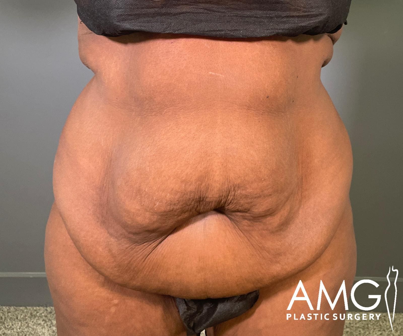 Front view of a woman's abdomen before fleur-de-lis tummy tuck showing excess skin and reduced abdominal contour, AMG Plastic Surgery.
