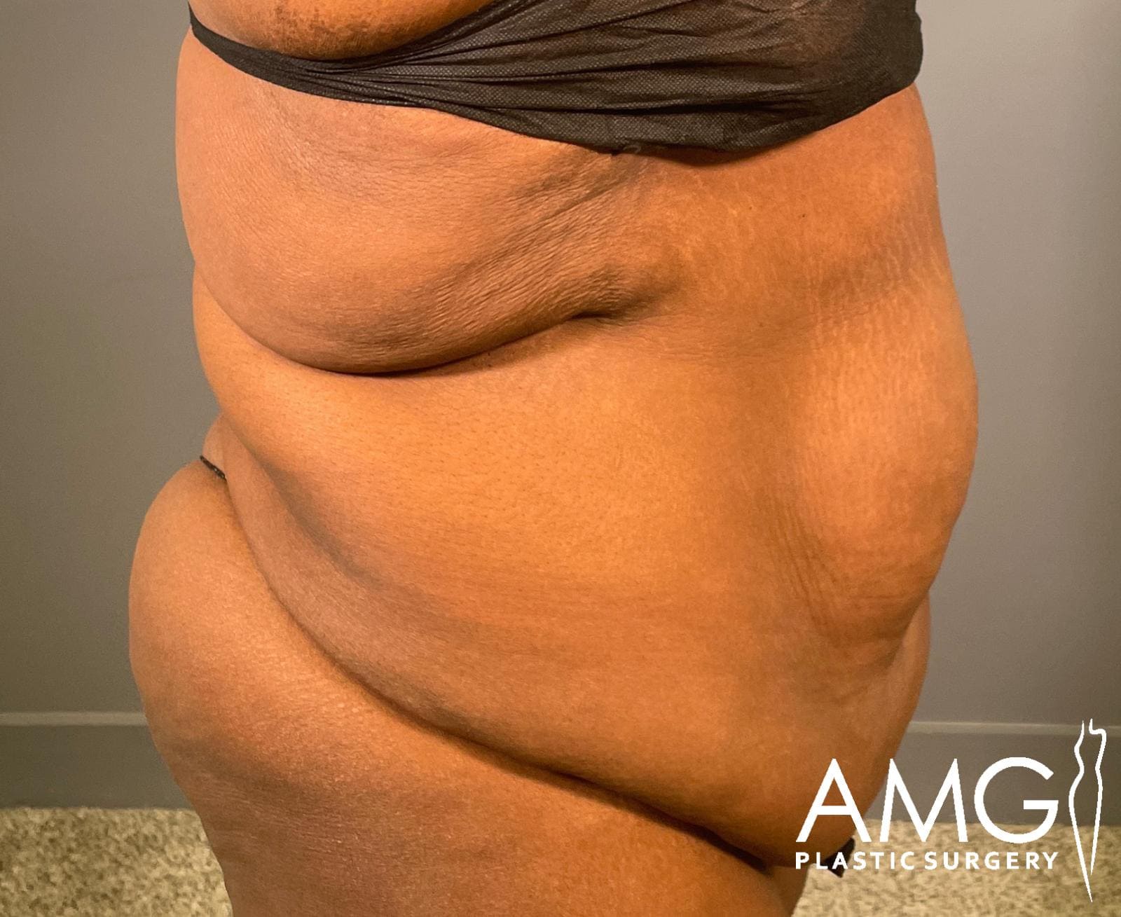Right view of a woman's abdomen before fleur-de-lis tummy tuck showing excess skin and reduced abdominal contour, AMG Plastic Surgery.