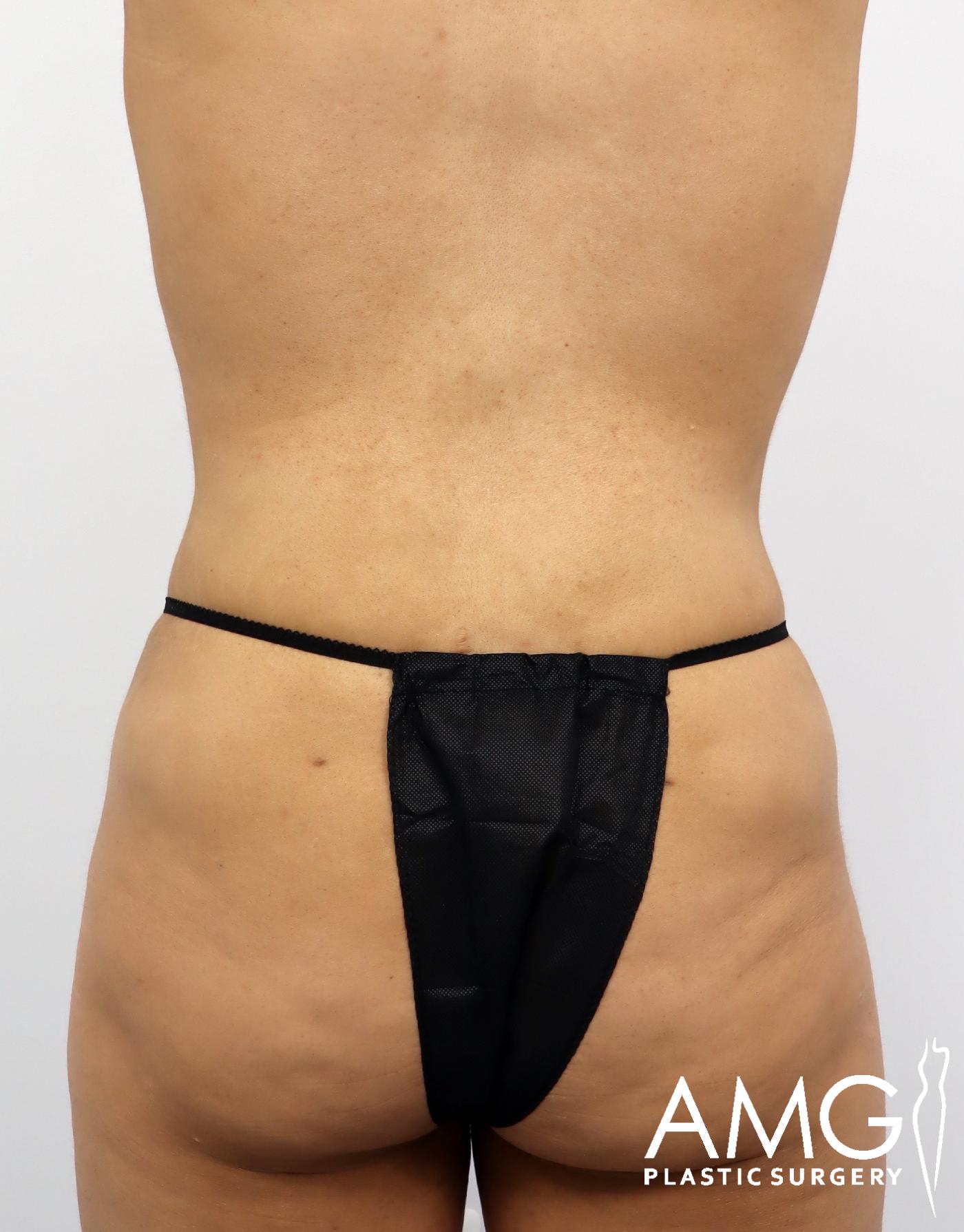 Back view of a woman's abdomen after Lipo 360 with J-Plasma showing improved contour, reduced fat, and smoother abdominal definition, AMG Plastic Surgery.