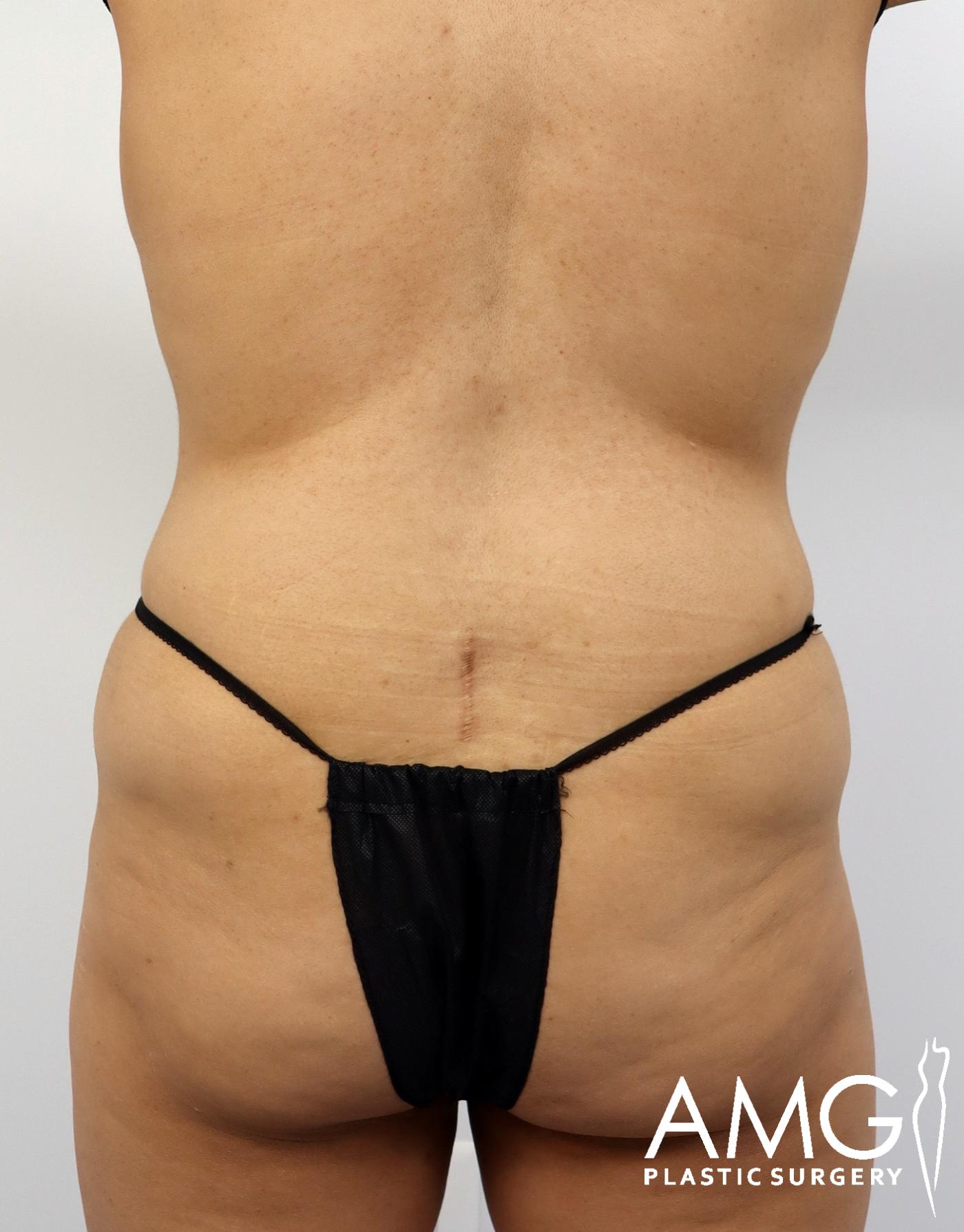 Back view of a woman's abdomen before Lipo 360 with J-Plasma showing excess fat and reduced abdominal contour, AMG Plastic Surgery.