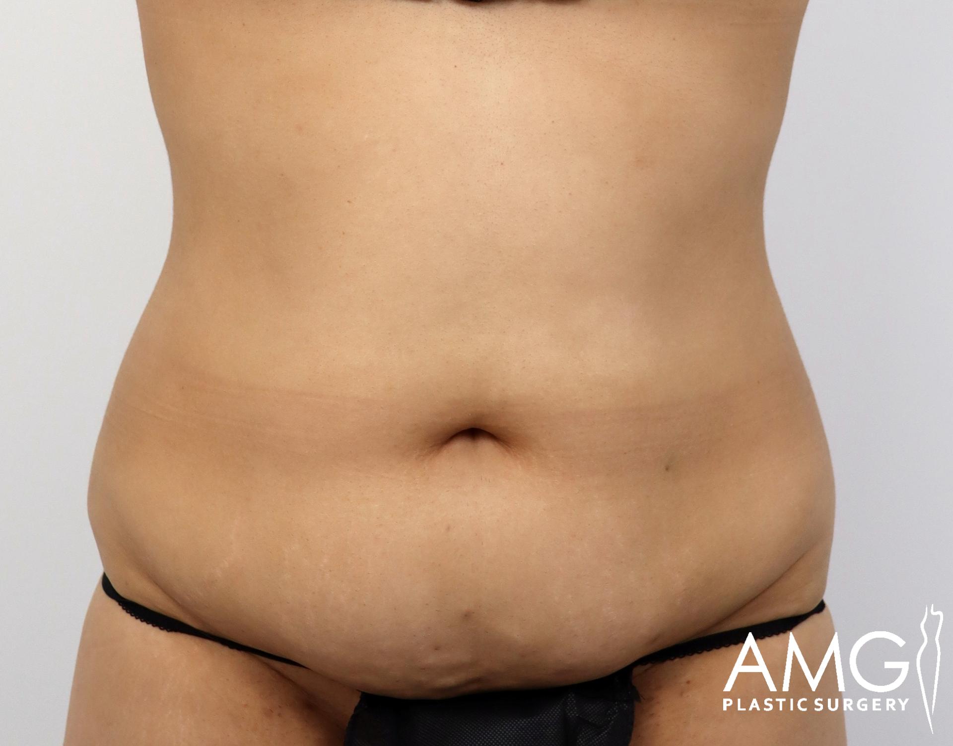 Front view of a woman's abdomen before Lipo 360 with J-Plasma showing excess fat and reduced abdominal contour, AMG Plastic Surgery.