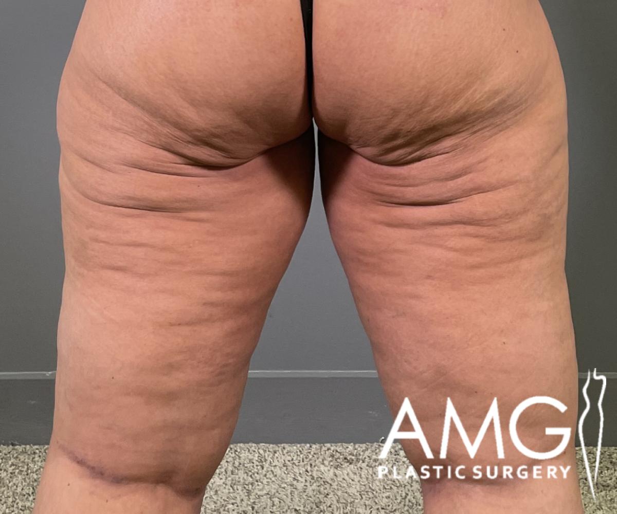 Back view of a woman's thighs after thigh contouring showing smoother leg shape, AMG Plastic Surgery.