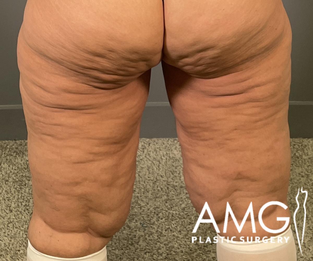 Back view of a woman's thighs before thigh contouring showing excess skin and tissue on the upper legs, AMG Plastic Surgery.