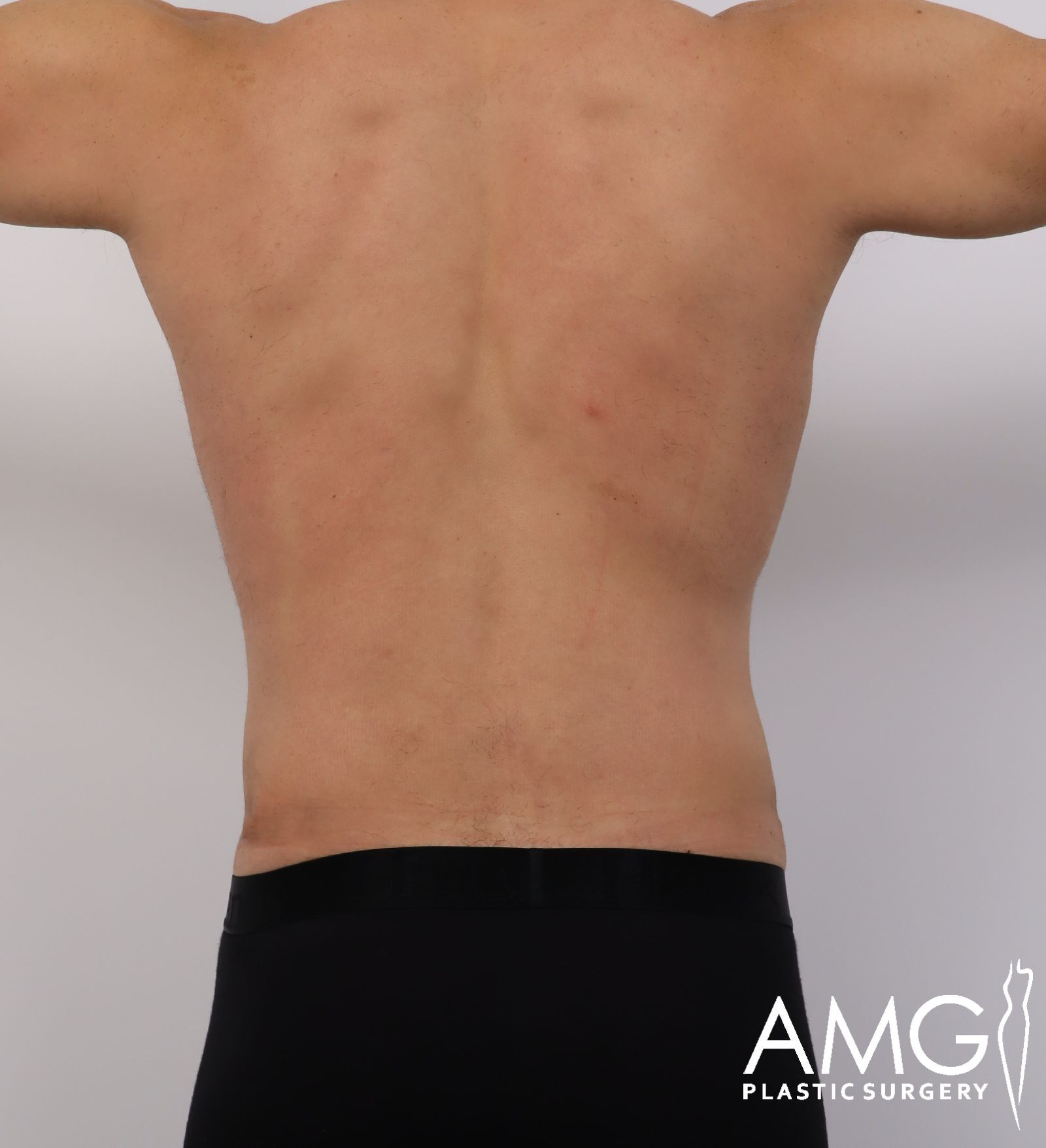Back view of a man's abdomen after tummy tuck showing a flatter and more contoured abdomen, AMG Plastic Surgery.